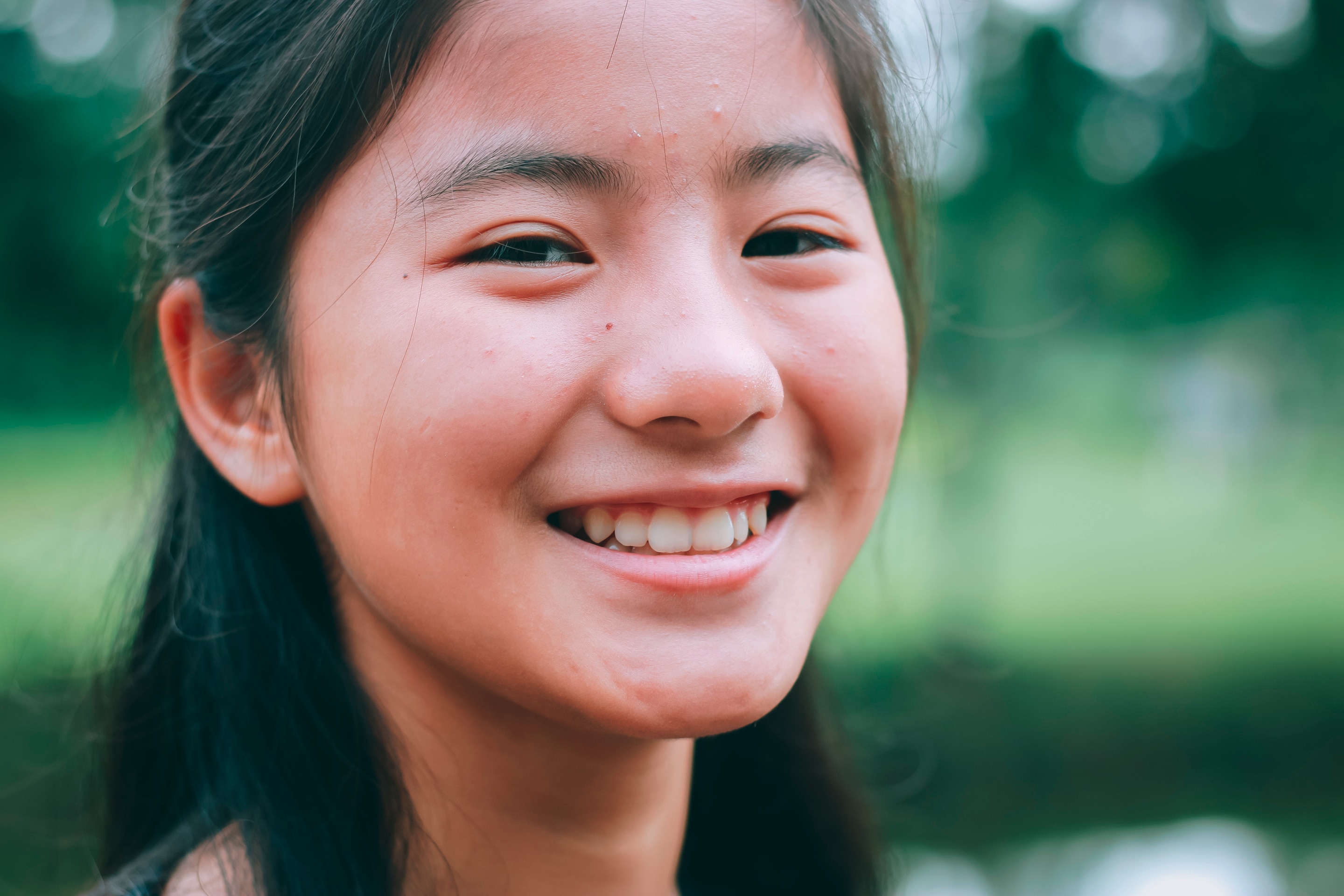 Happy Asian teen with pimples on face.