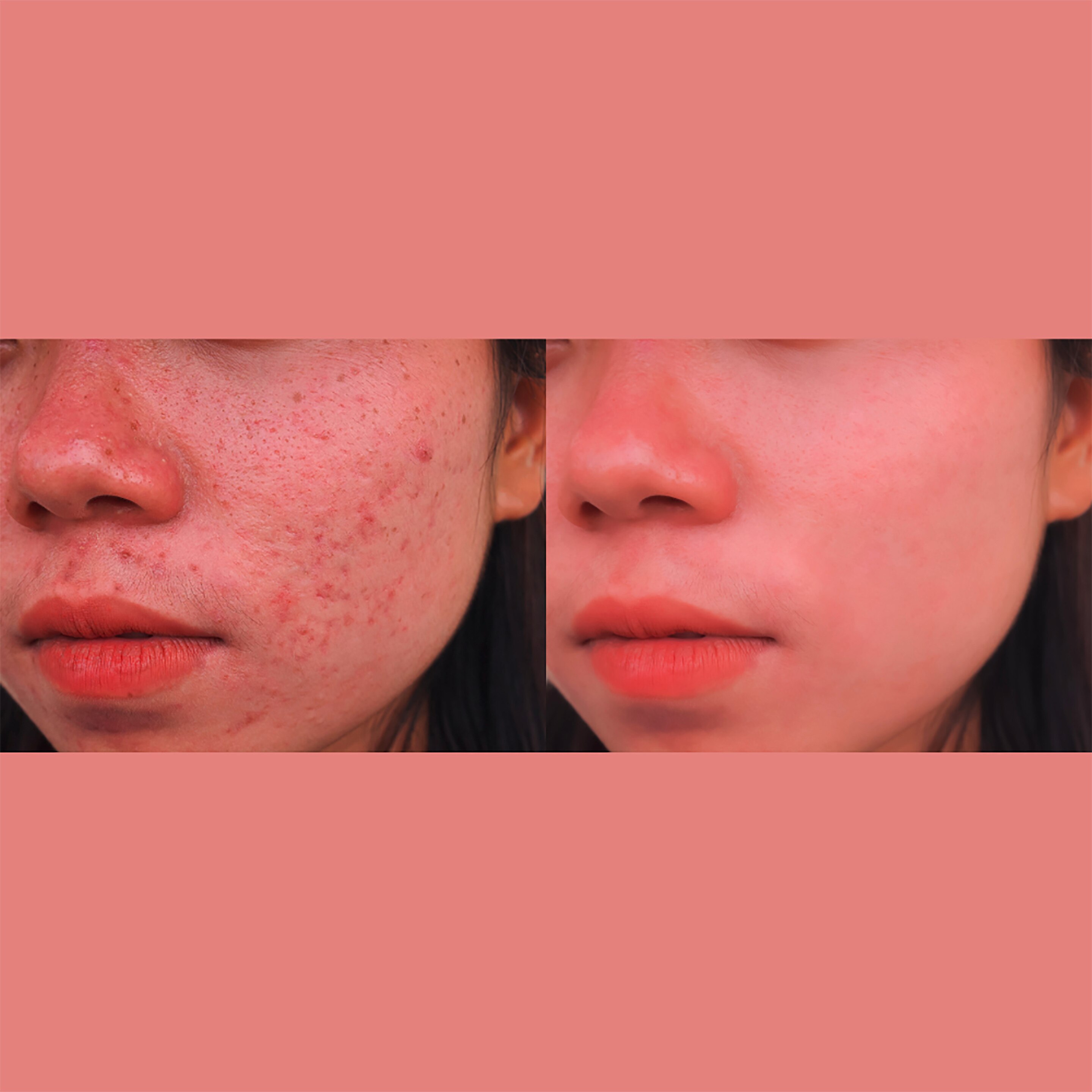 Before and after image of woman with acne scars on face.