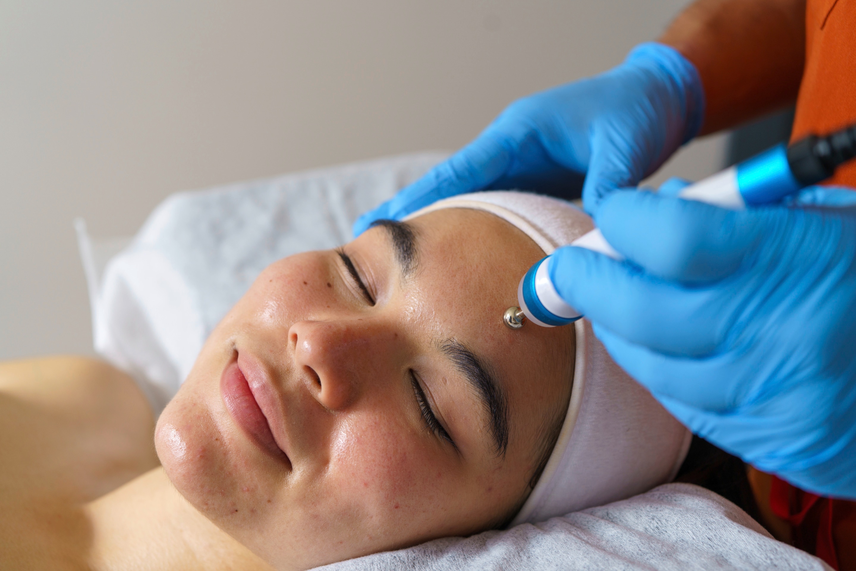 Woman getting treatment for ice pick acne scars.
