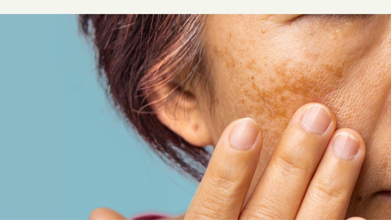 What Causes Dark Spots on the Face?