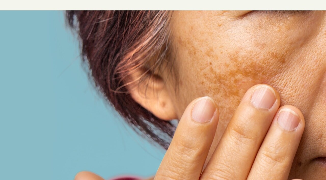 What Causes Dark Spots on the Face?