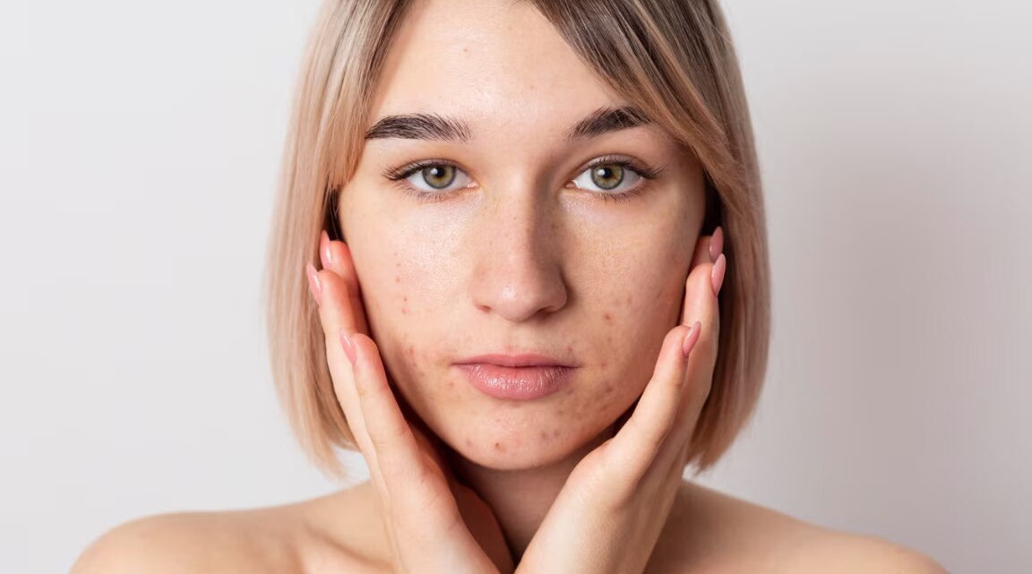 How to Remove Black Spots on Face: Causes, Remedies & Quick Fixes
