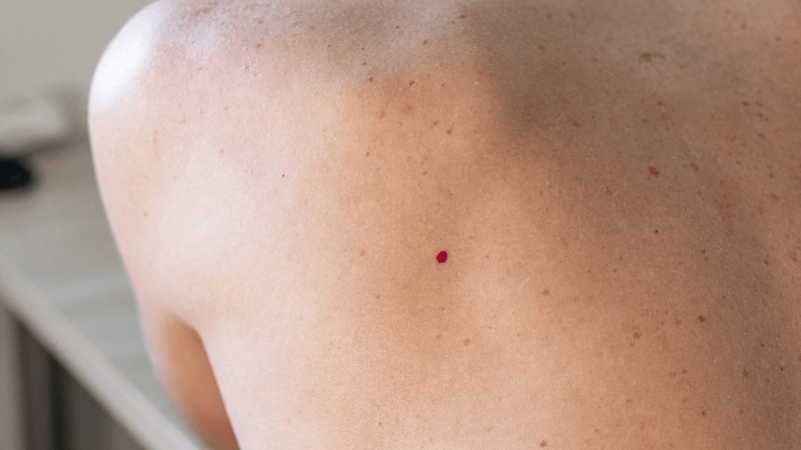 A Dermatologist's Guide To Dealing With Cherry Angiomas - The Little Red Moles That Develop With Age