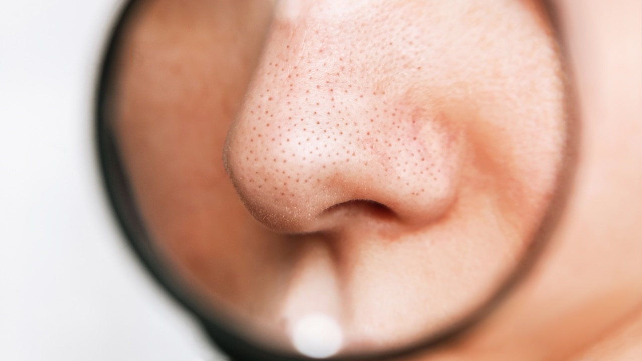 Clogged Pores