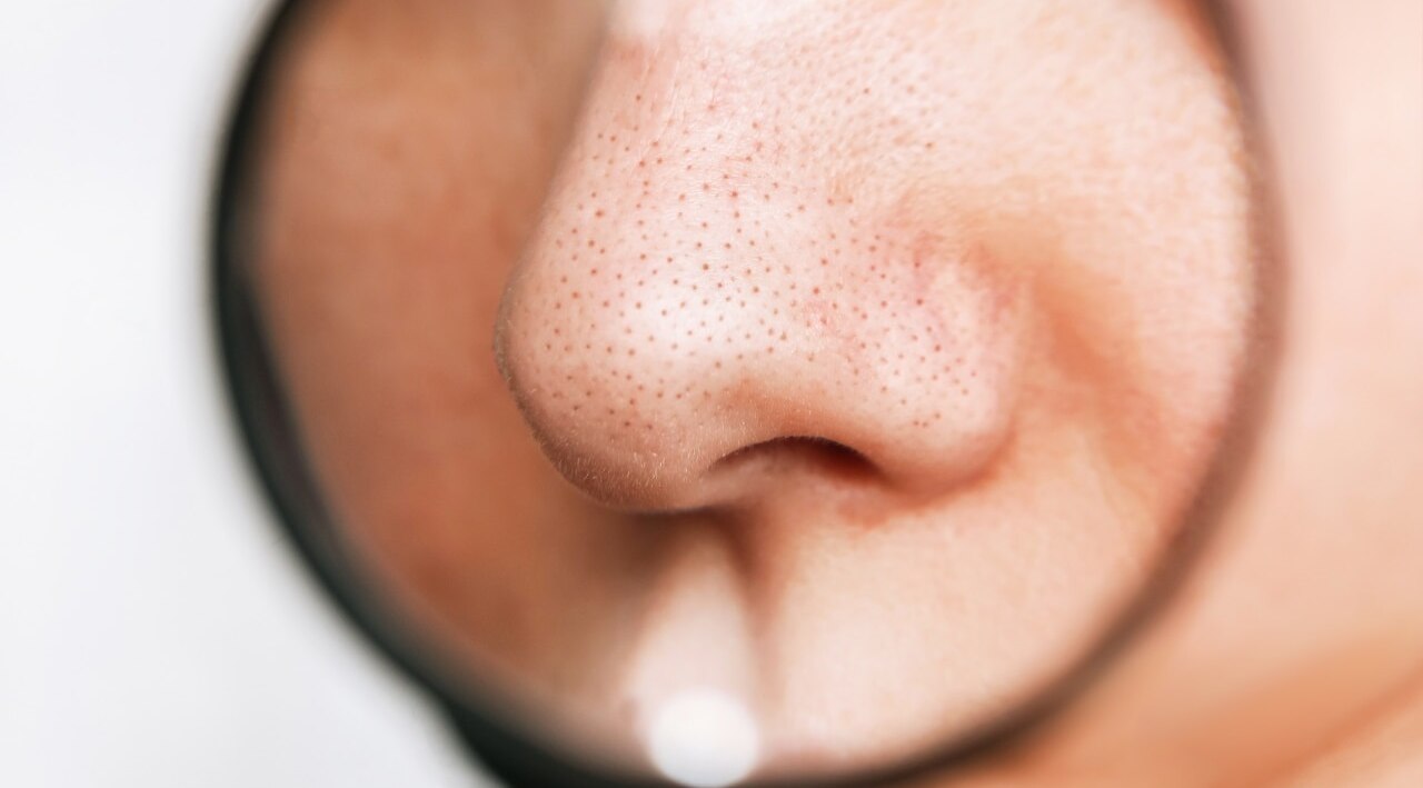 Clogged Pores