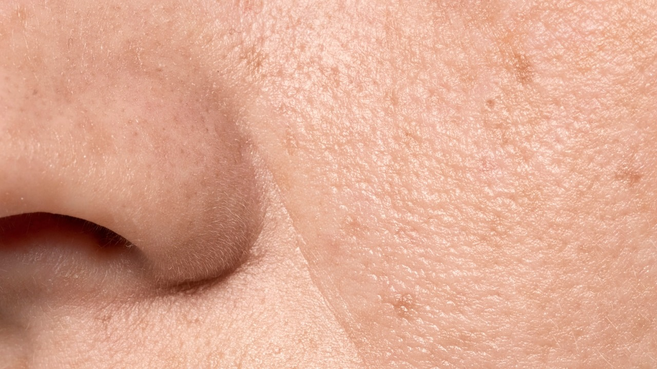 Overproduction of Oil (Sebum)