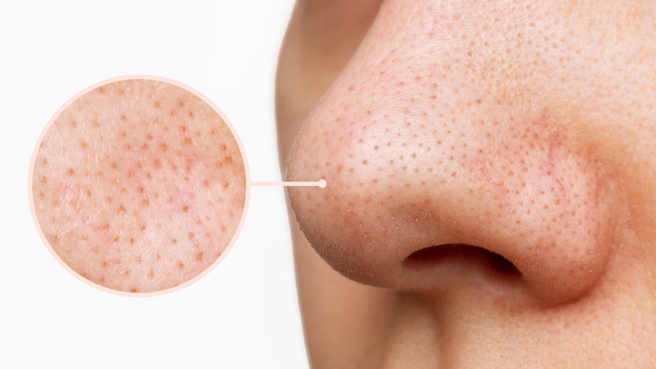 Unclogs Pores, Prevents Future Breakouts