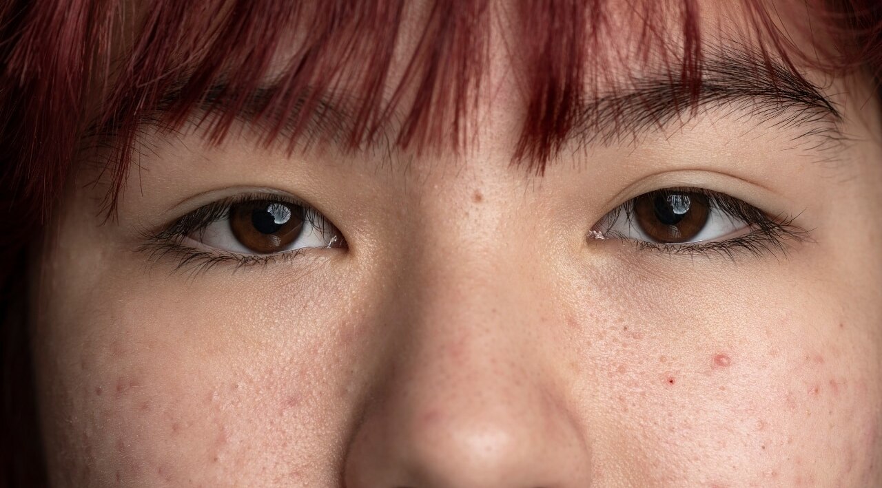 What Causes Open Pores and Textured Skin