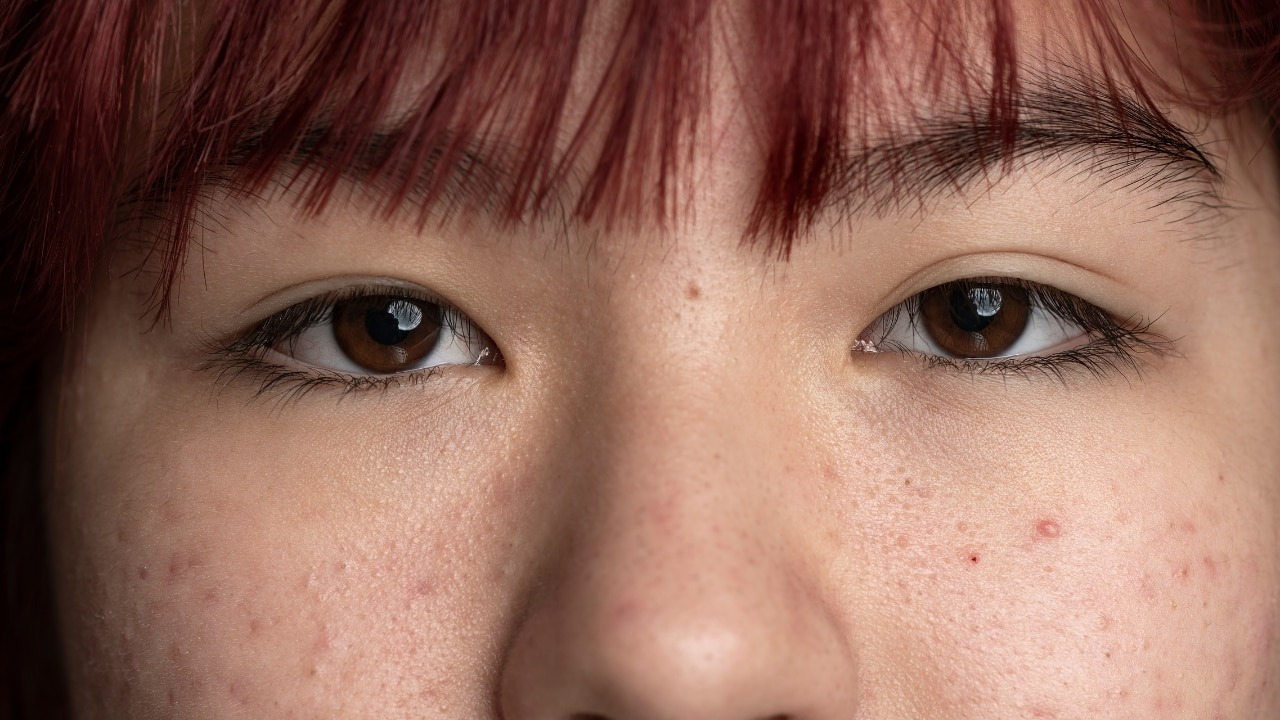 What Causes Open Pores and Textured Skin