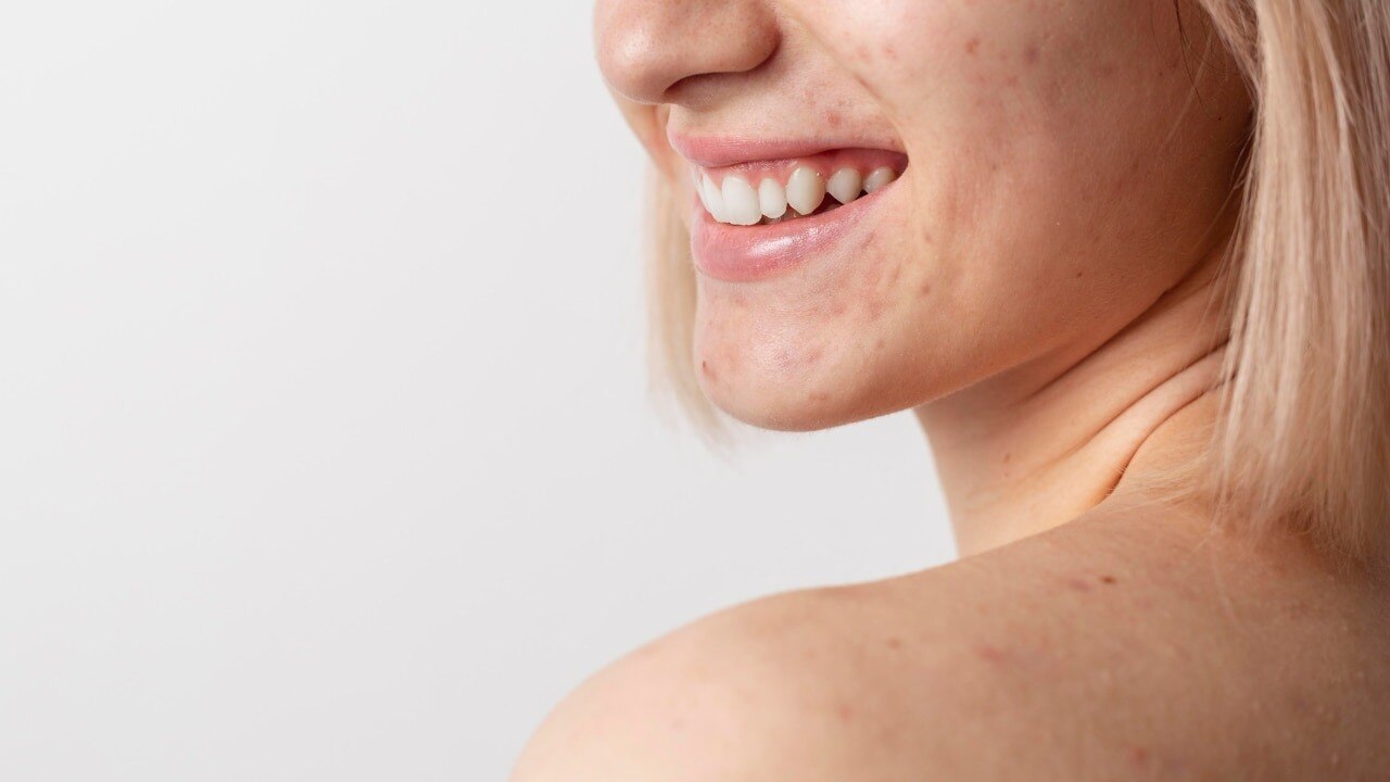 What Are Whiteheads?