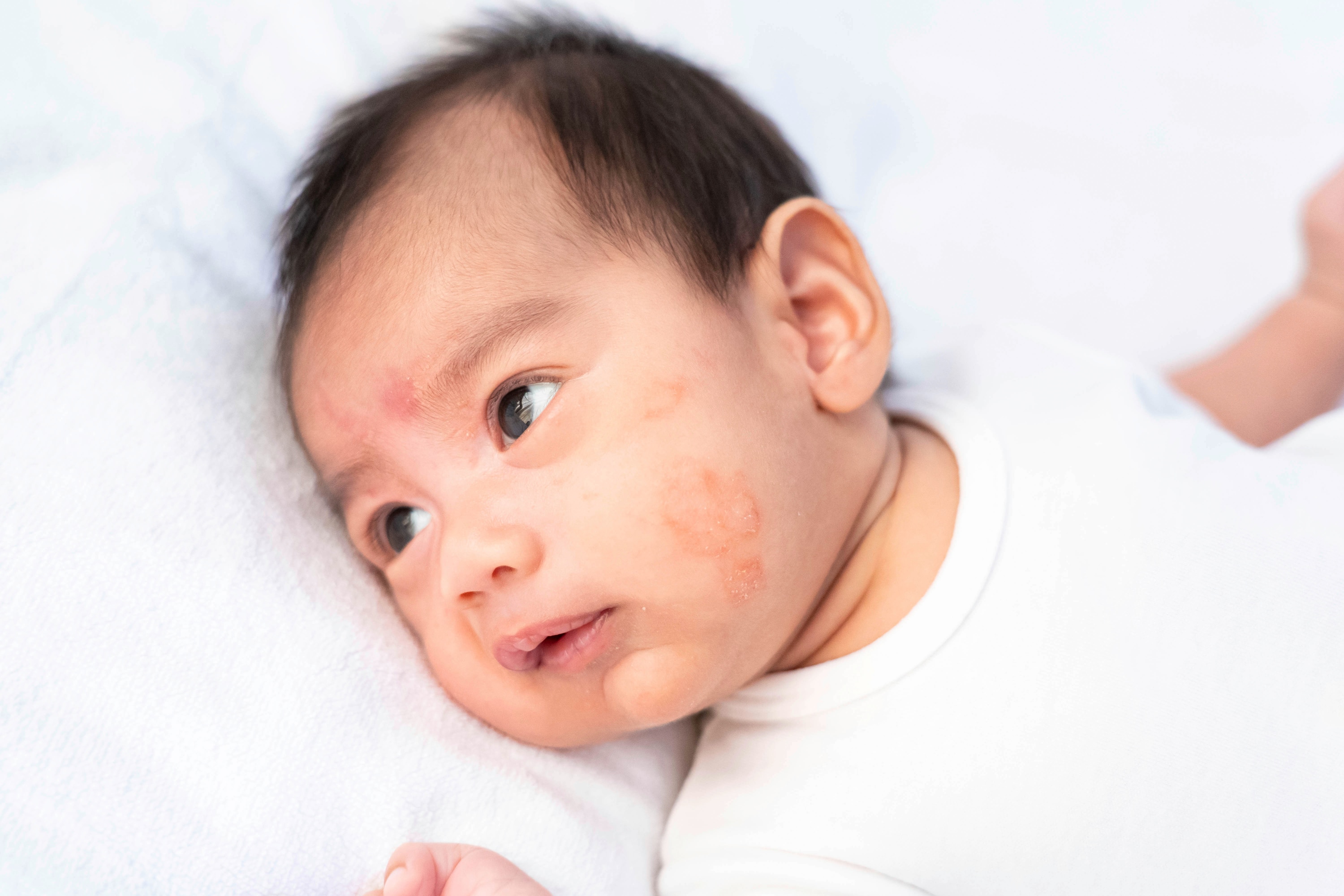 wajah bayi baru lahir dengan bercak kemerahan akibat eksim atau dermatitis atopik pada pipi, terlihat kulit kering dan iritasi