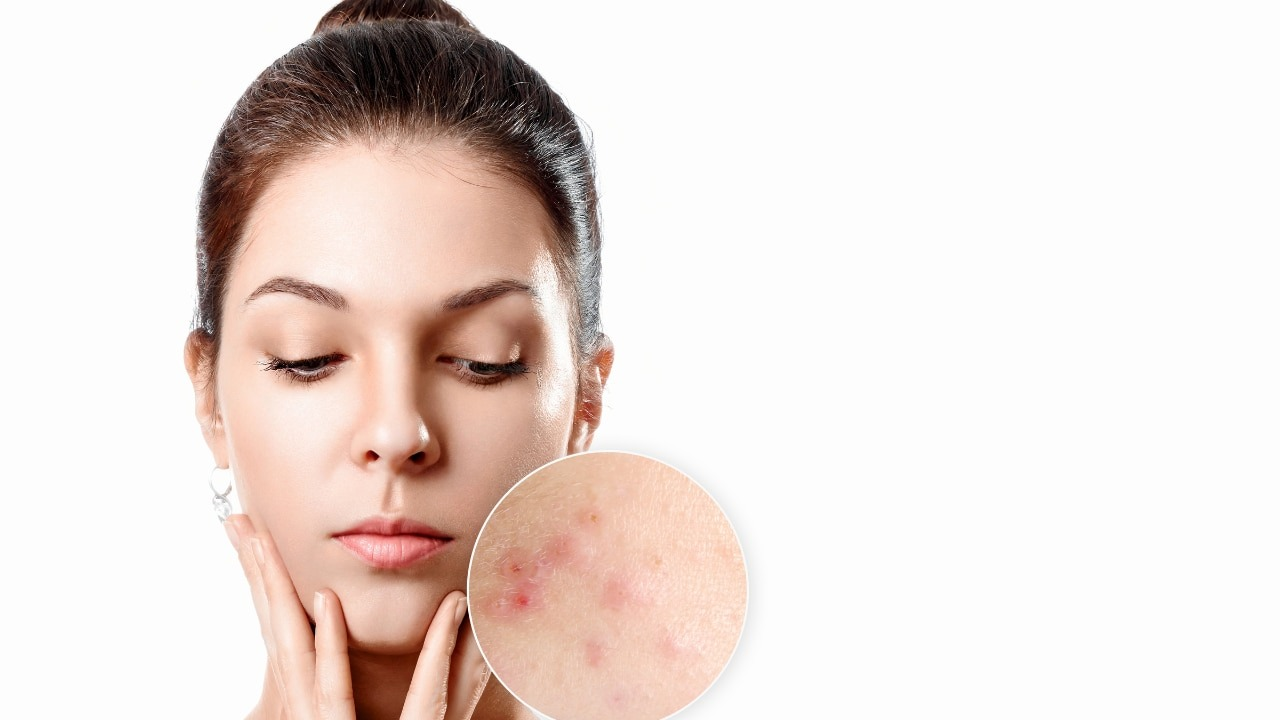 Prevents acne