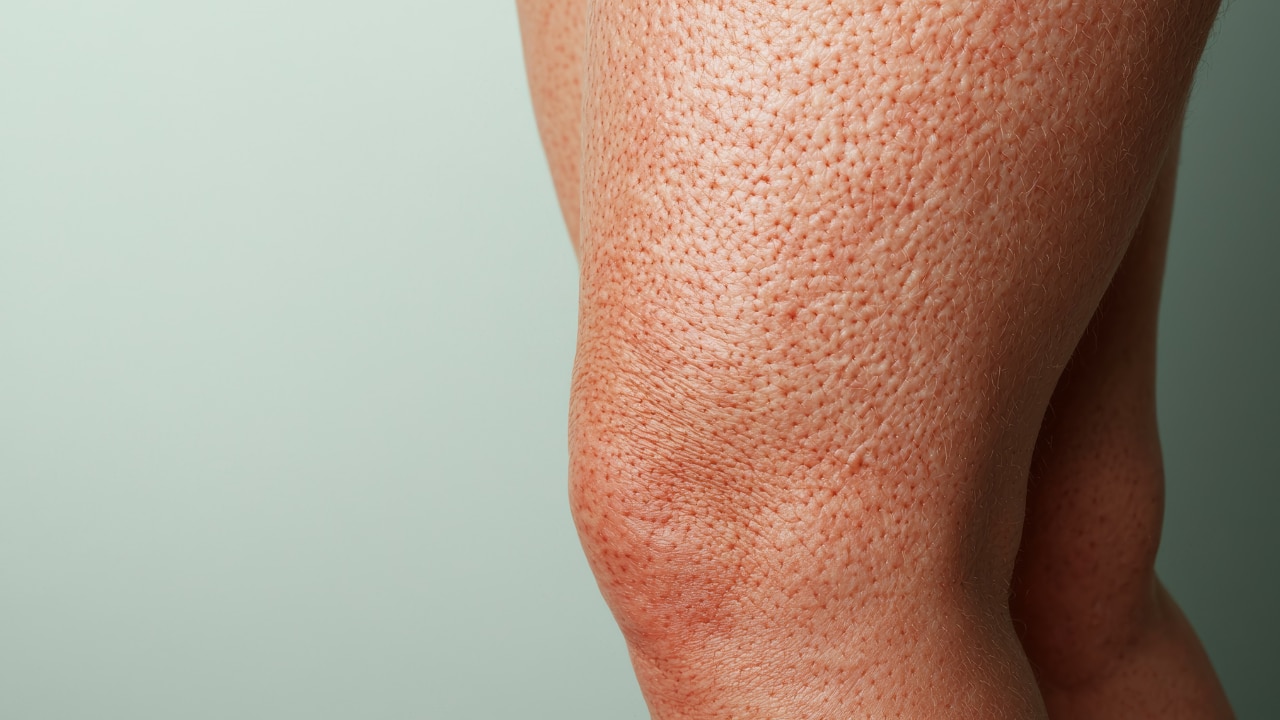 Clogged pores image