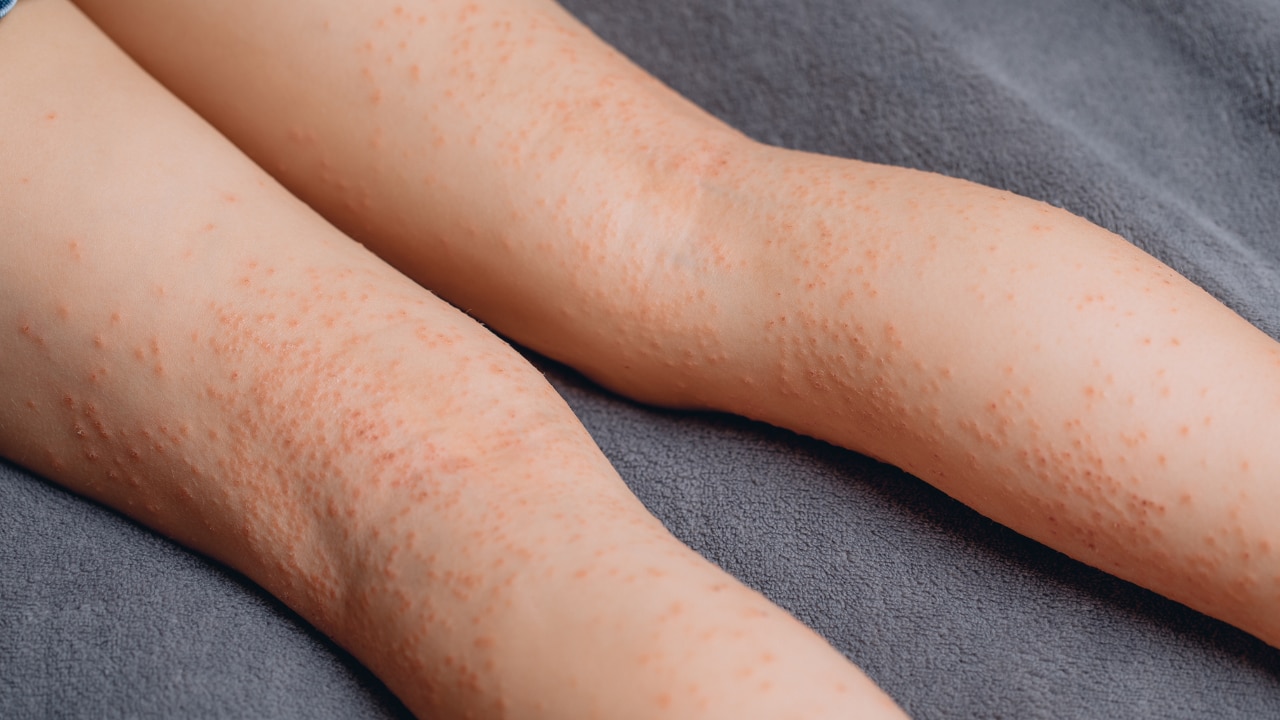 Folliculitis image