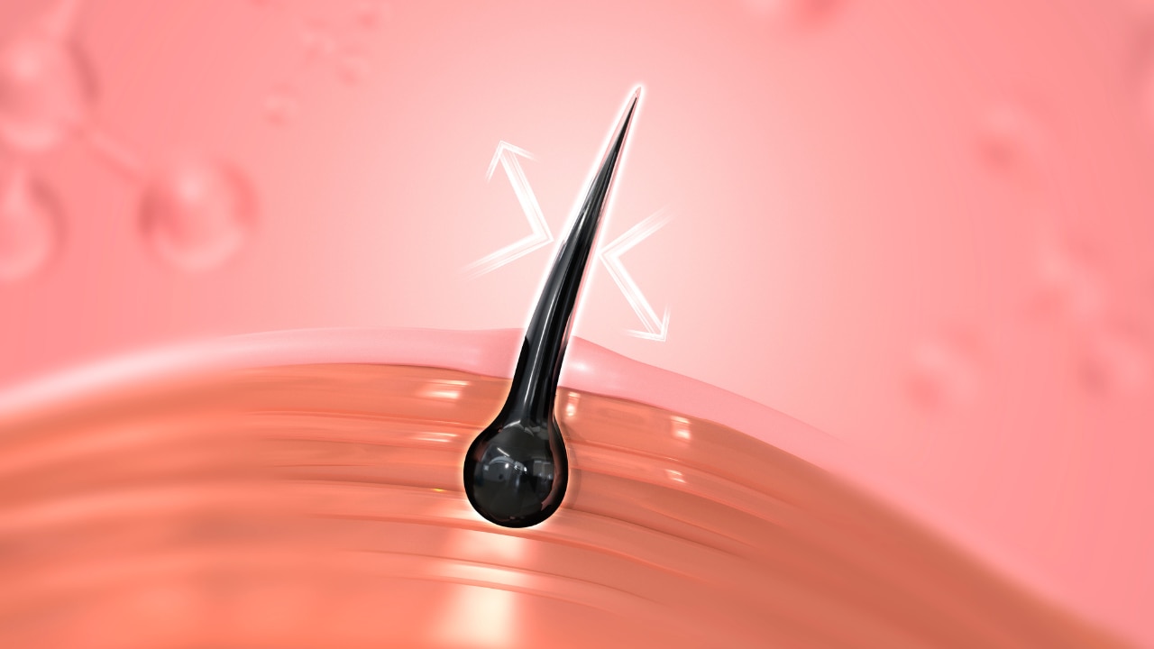 Ingrown hairs image
