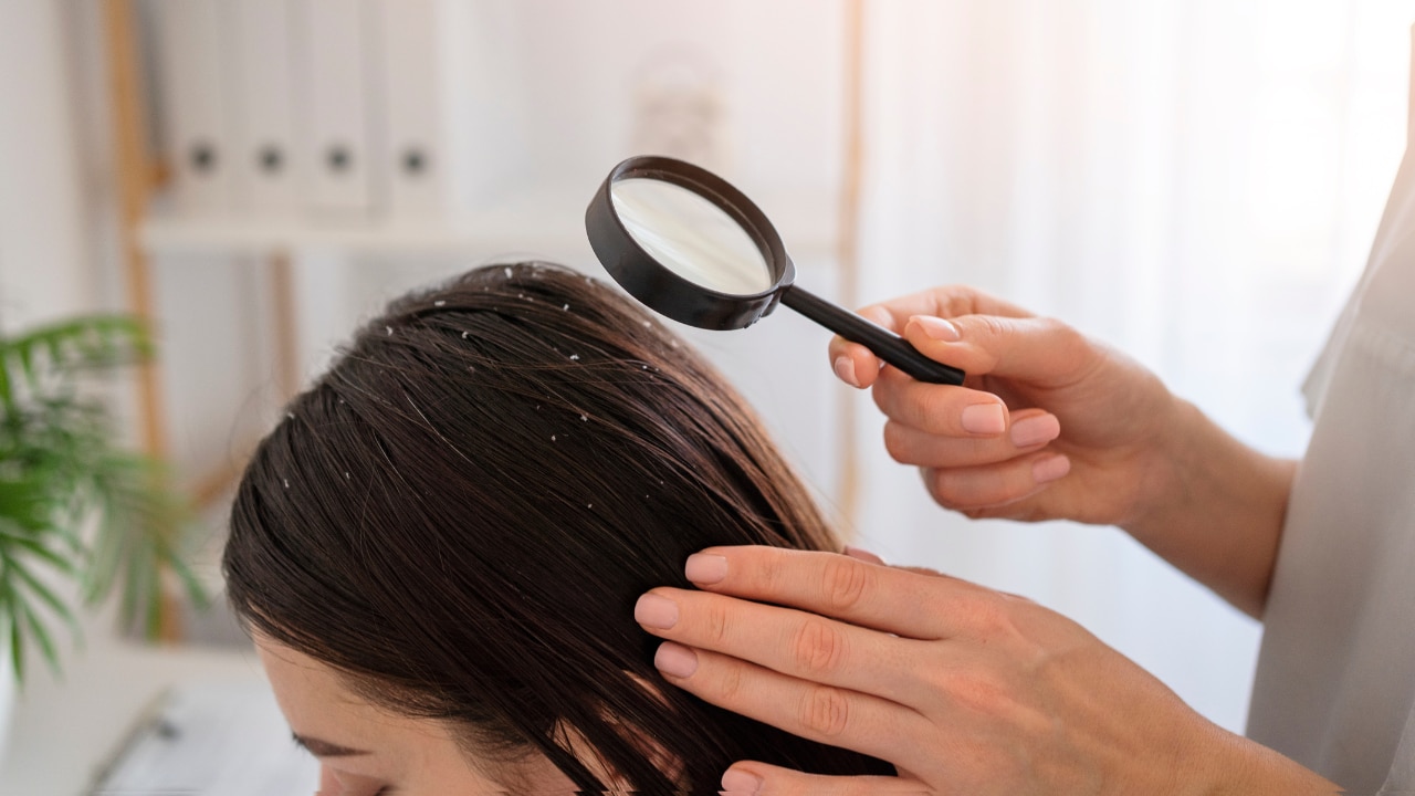 Dandruff control image