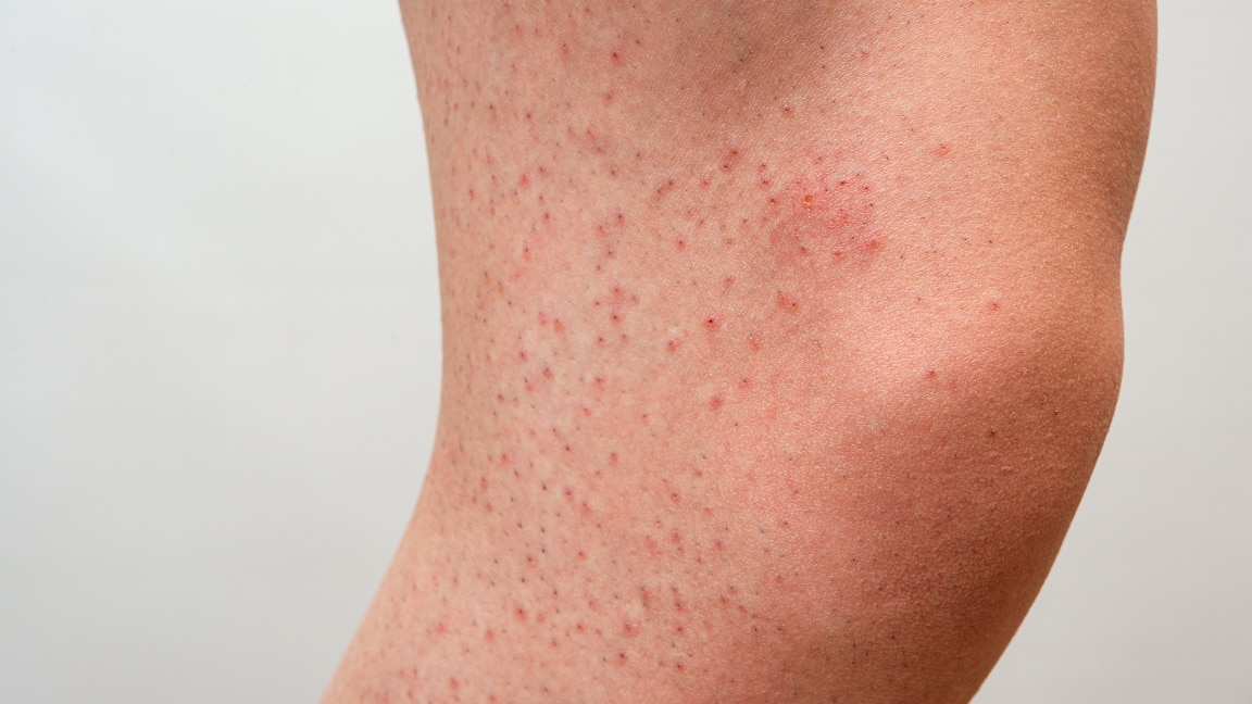 how to get rid of strawberry legs