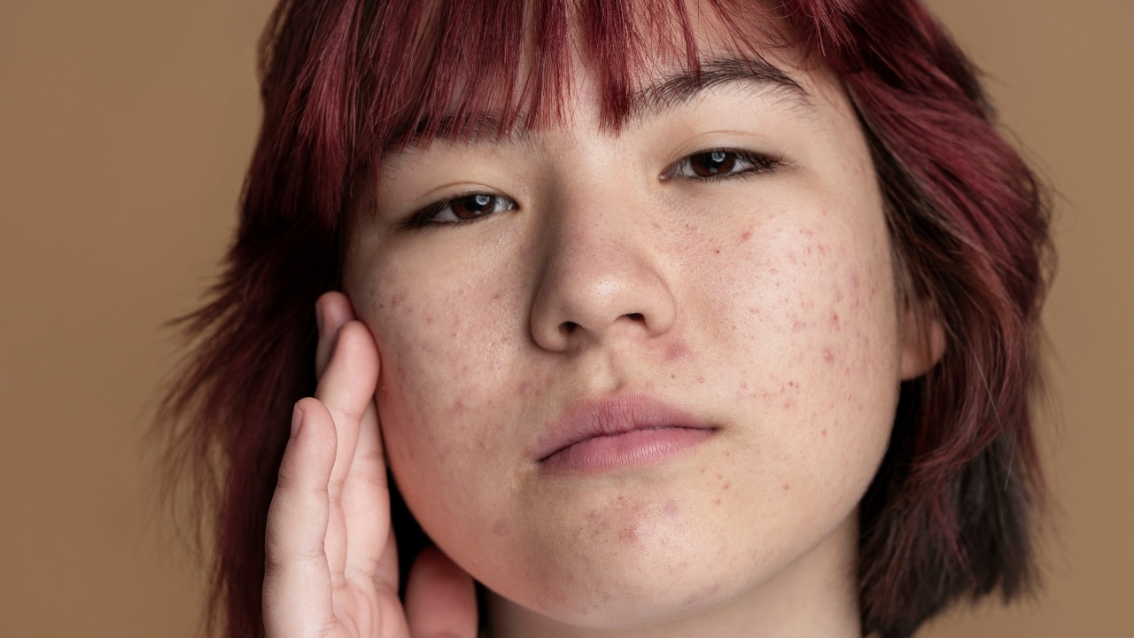 What is Uneven Skin Texture image