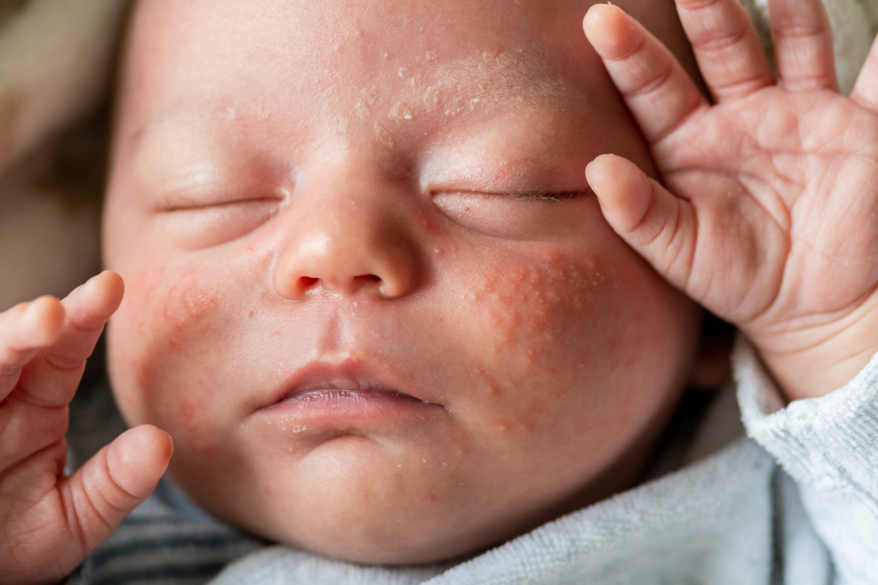 Wajah bayi baru lahir dengan bintik-bintik di pipi akibat milia