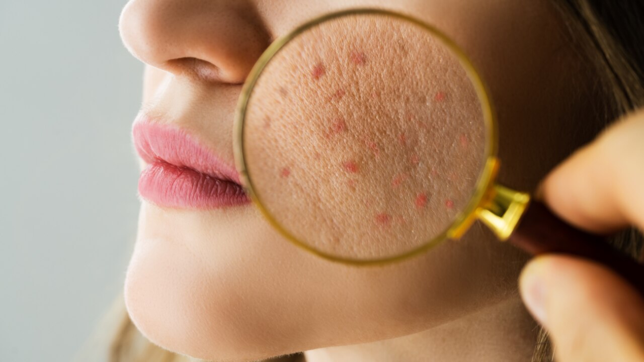 Skin Barrier Repair