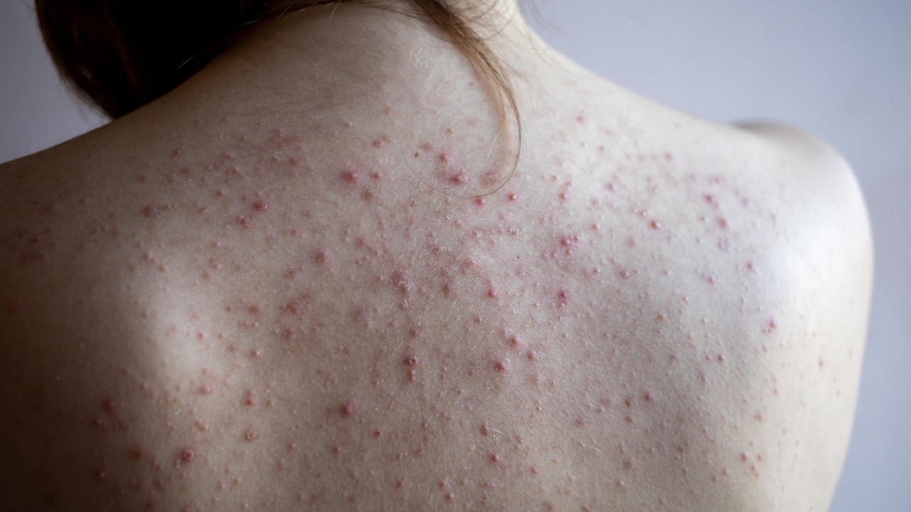 Body Acne (Chest, Back, Shoulders) Image