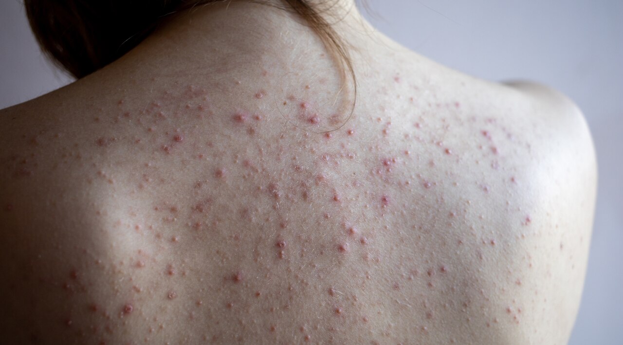 Body Acne (Chest, Back, Shoulders) Image