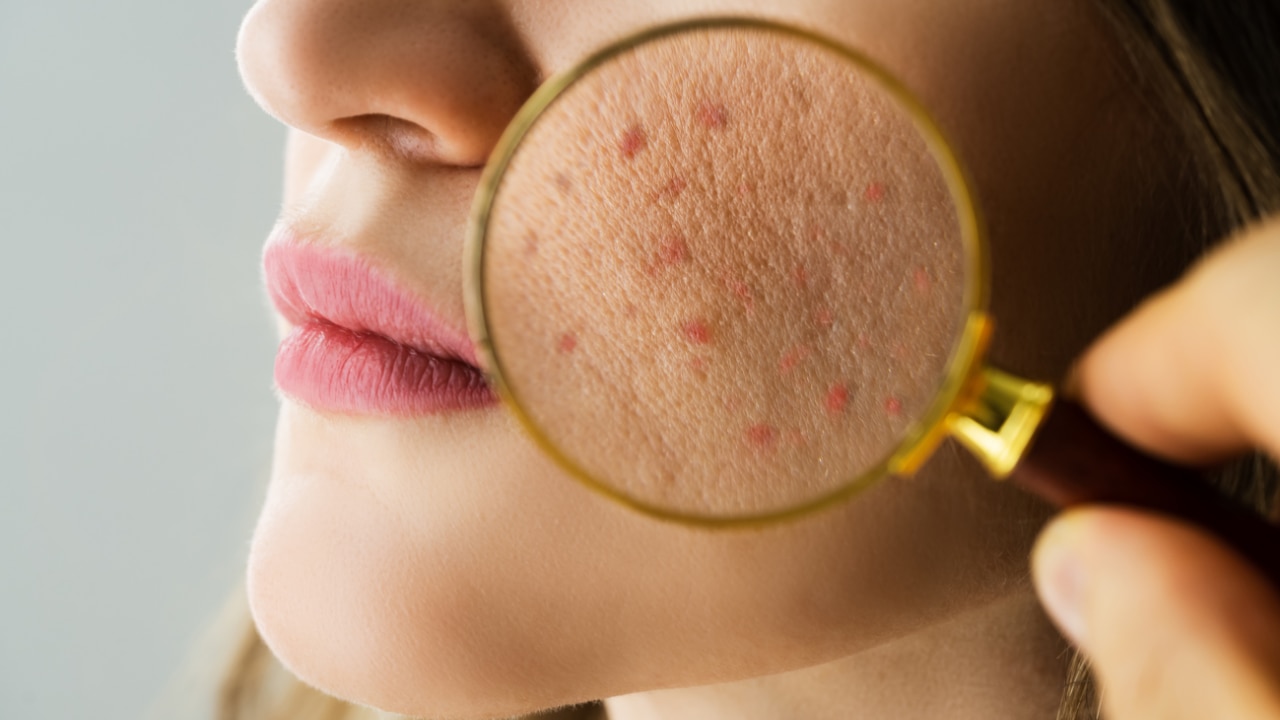 Spot Treatment for Pimples Image
