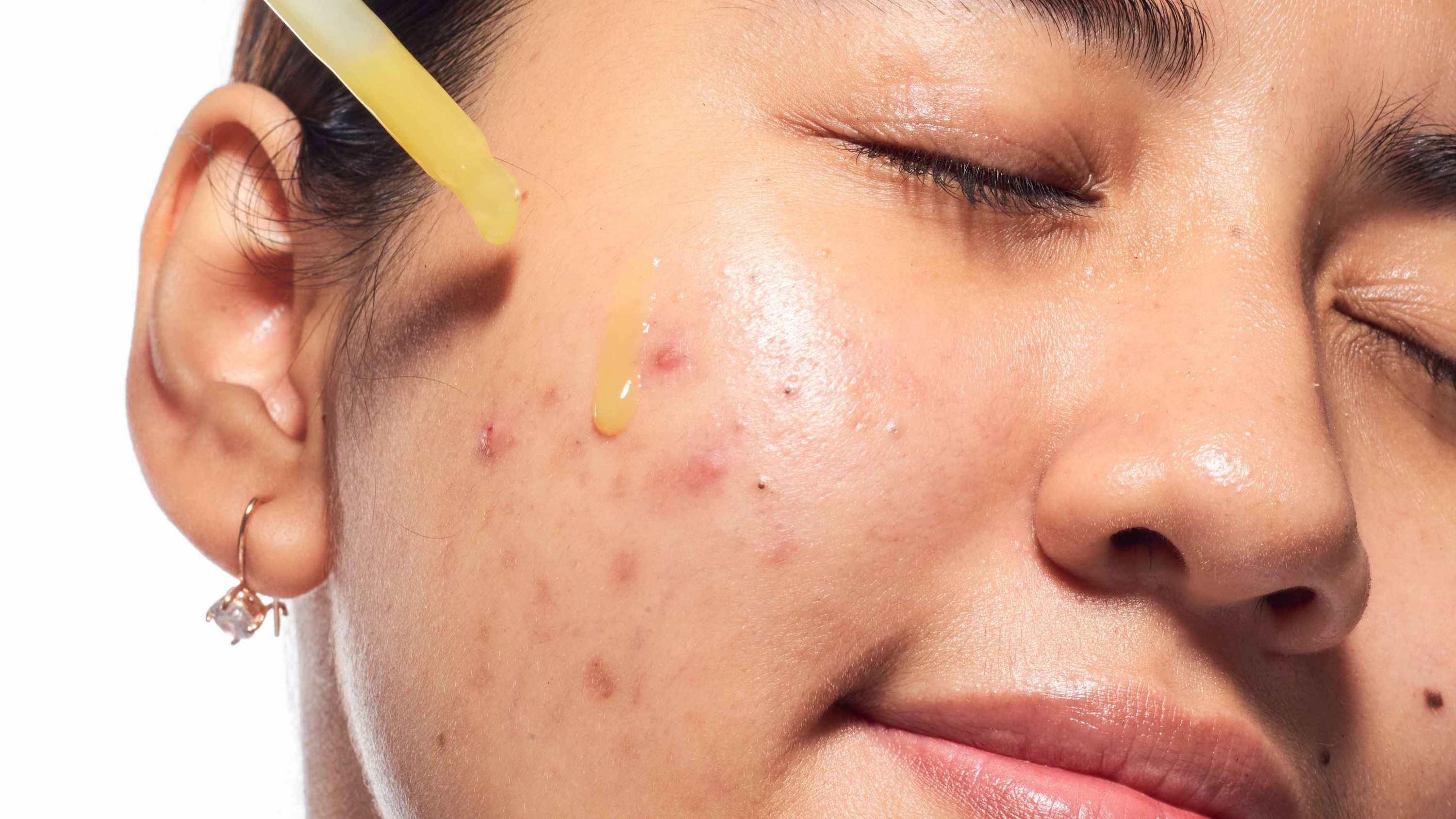 Blemish Serums and Spot Treatments