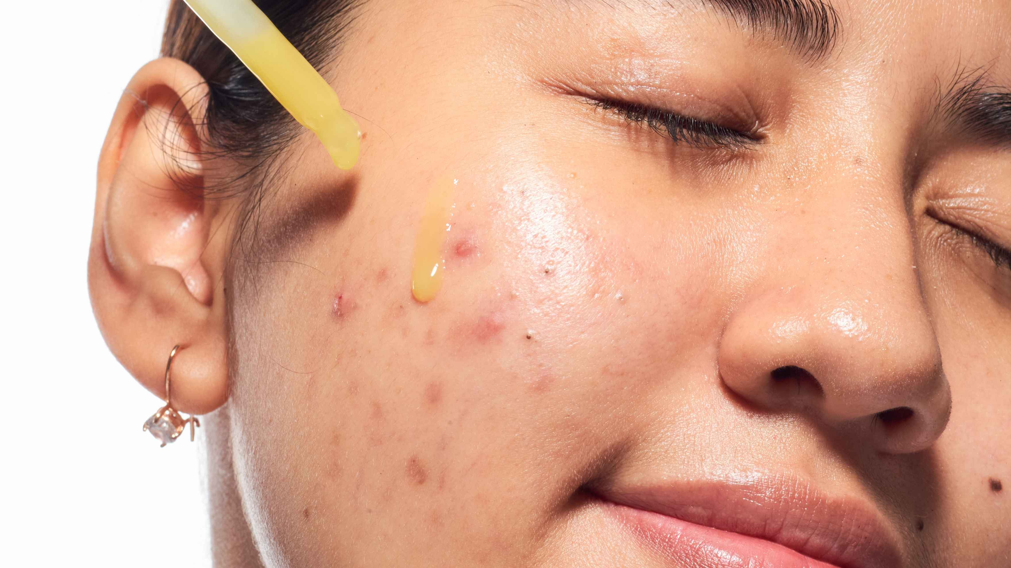 Blemish Serums and Spot Treatments
