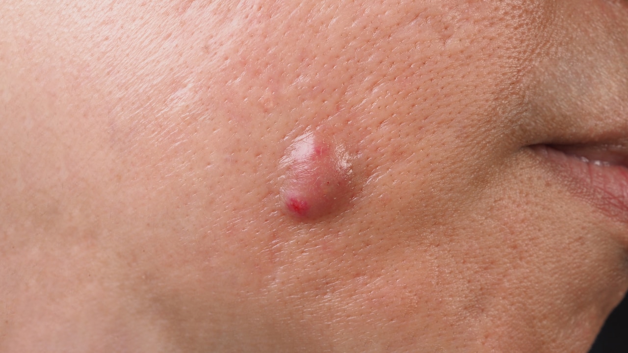 Nodules and Cysts