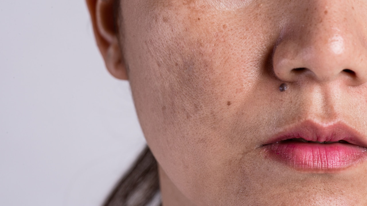 Dark Spots
