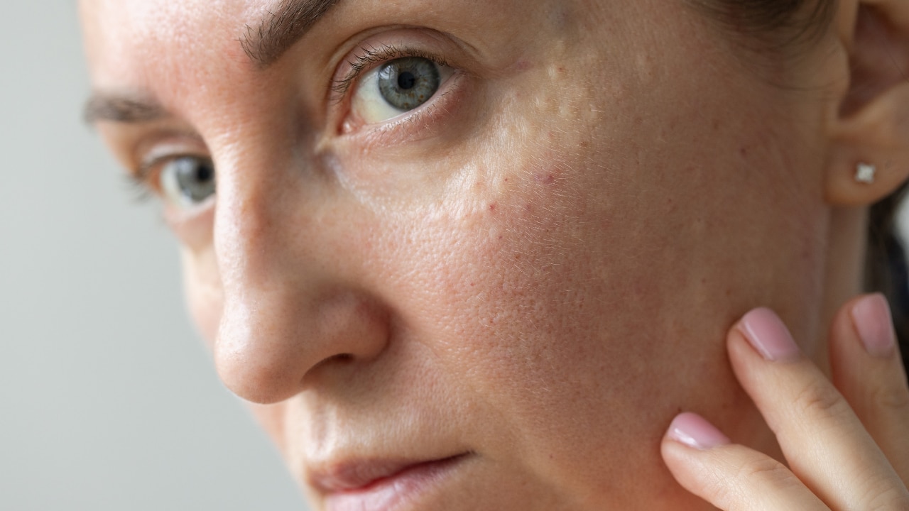 Papules and Pustules