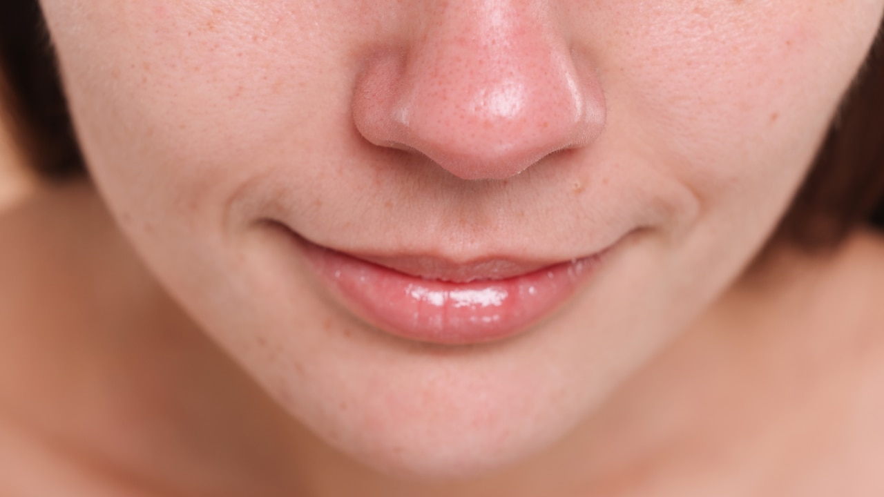 Whiteheads and Blackheads