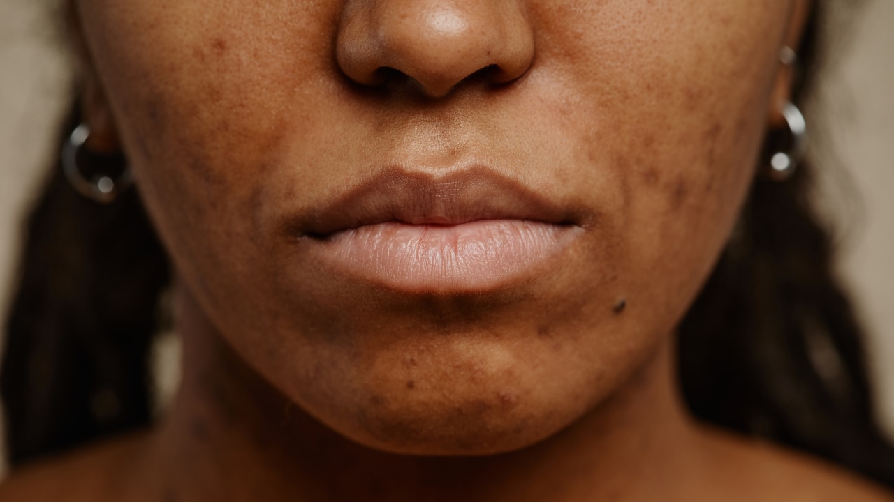 What are Blemishes