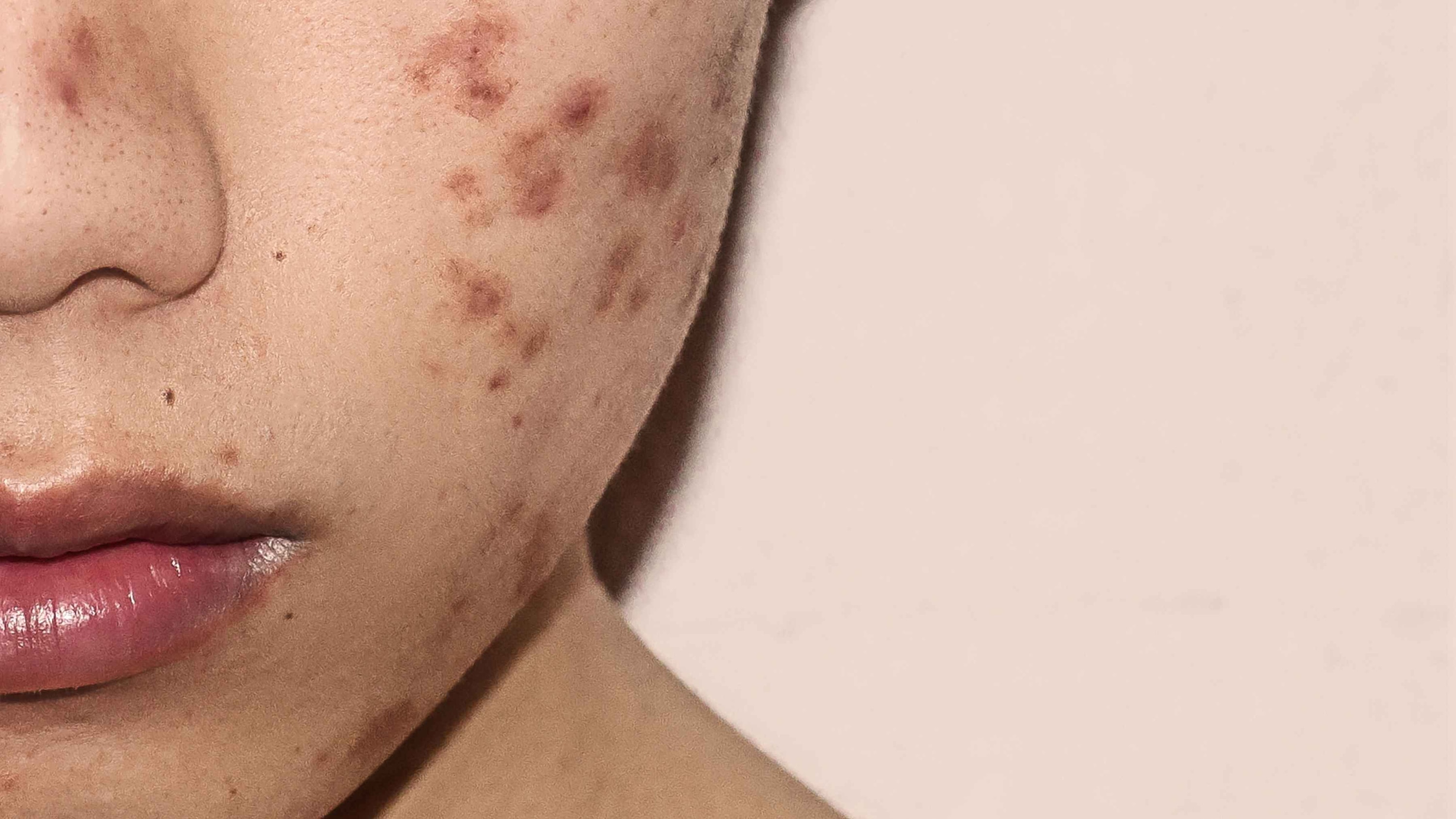Blemishes on Face - Causes and Best Treatments for Clearer Skin
