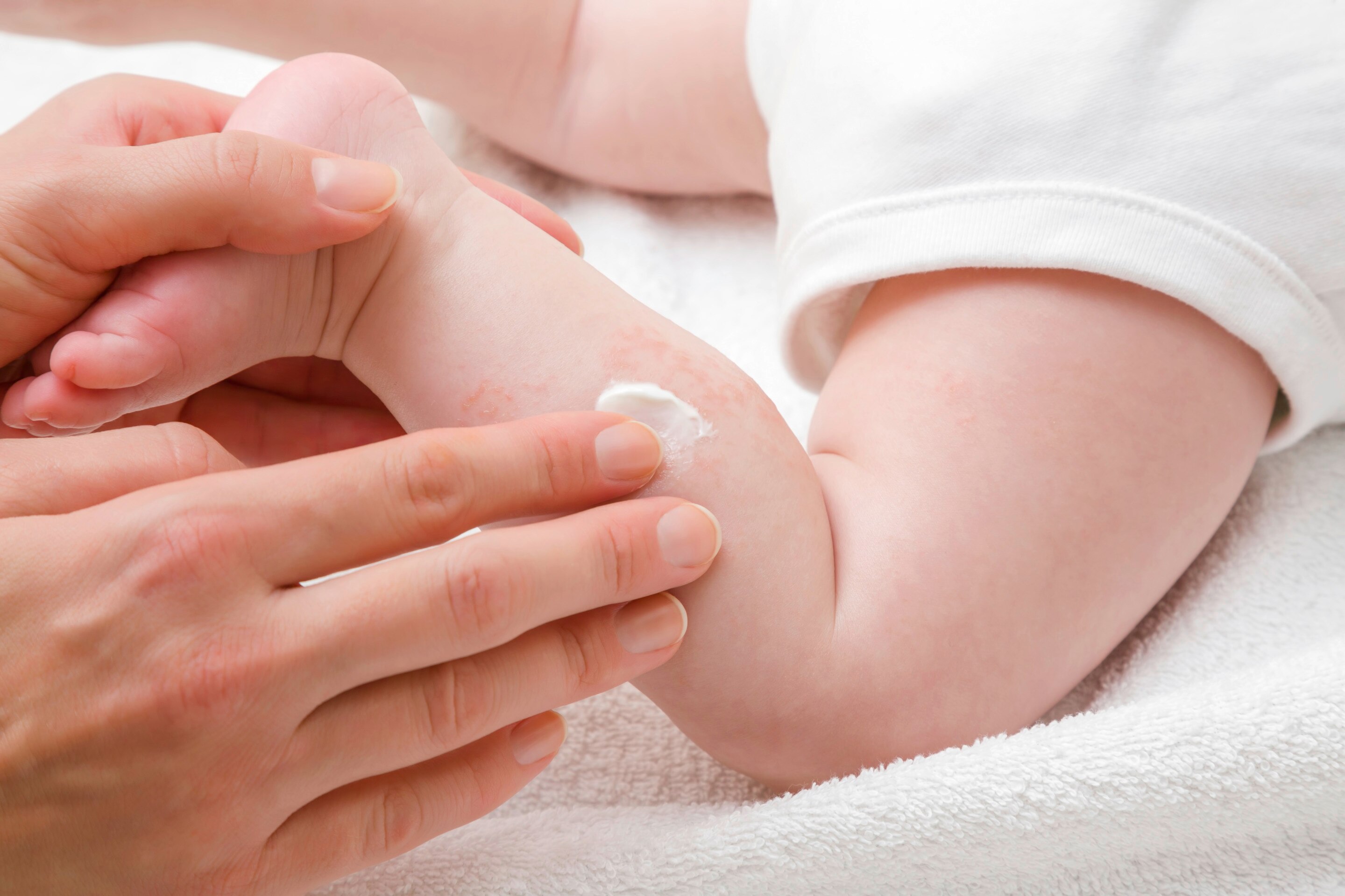 Ibu dengan hati-hati mengoleskan salep pada kaki bayi yang sedang biduran