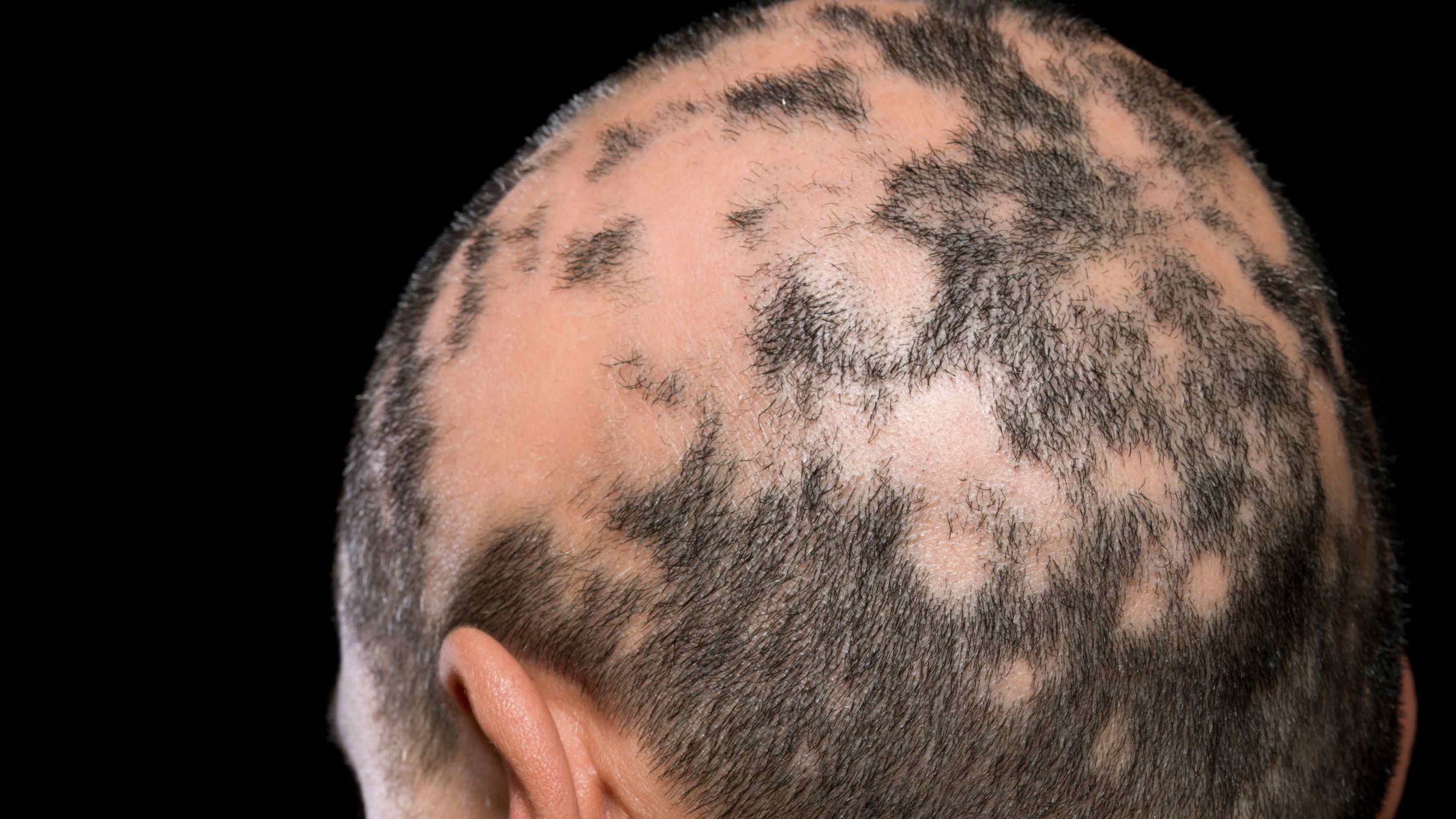 Alopecia Areata Image