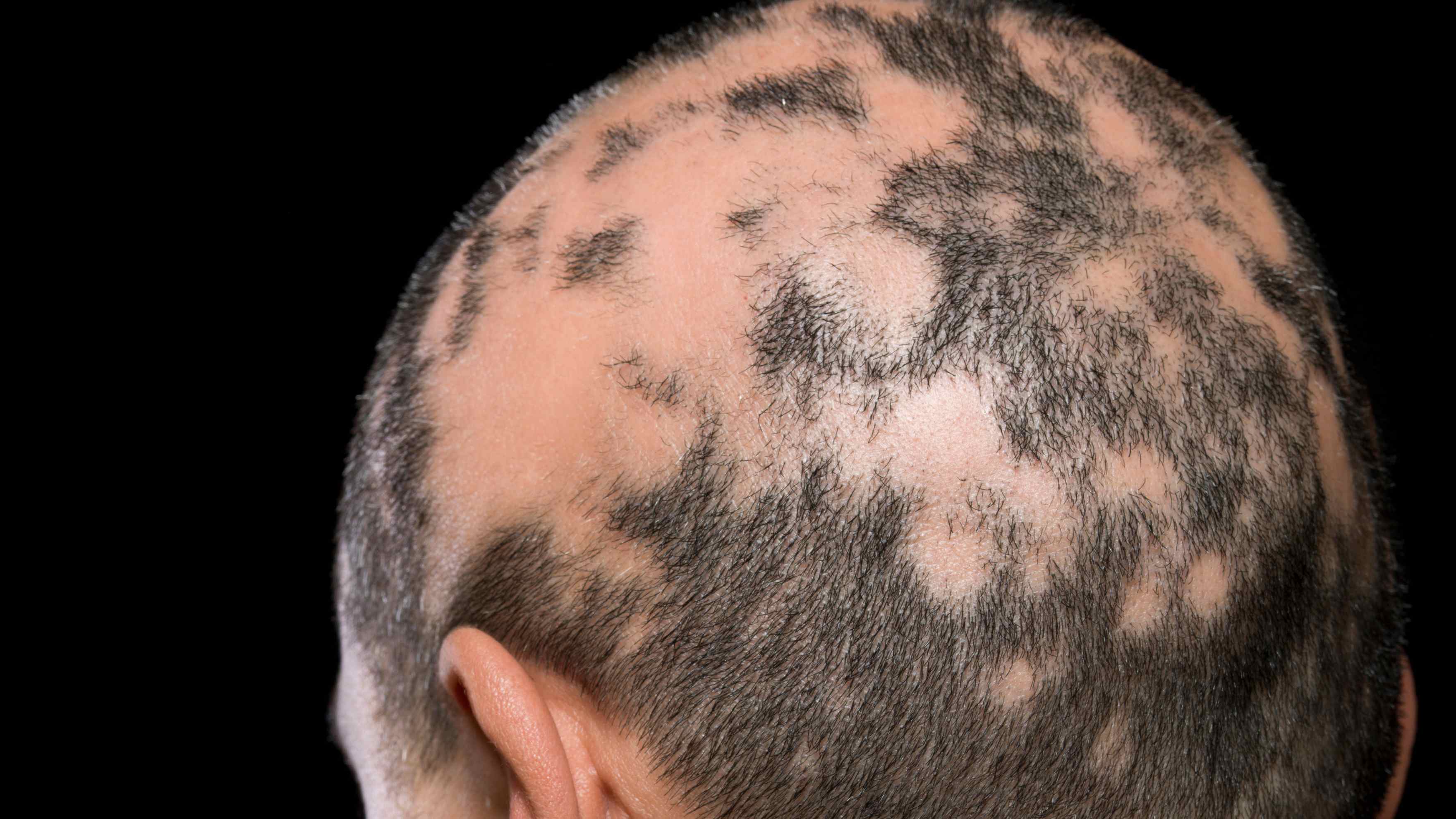 Alopecia Areata Image