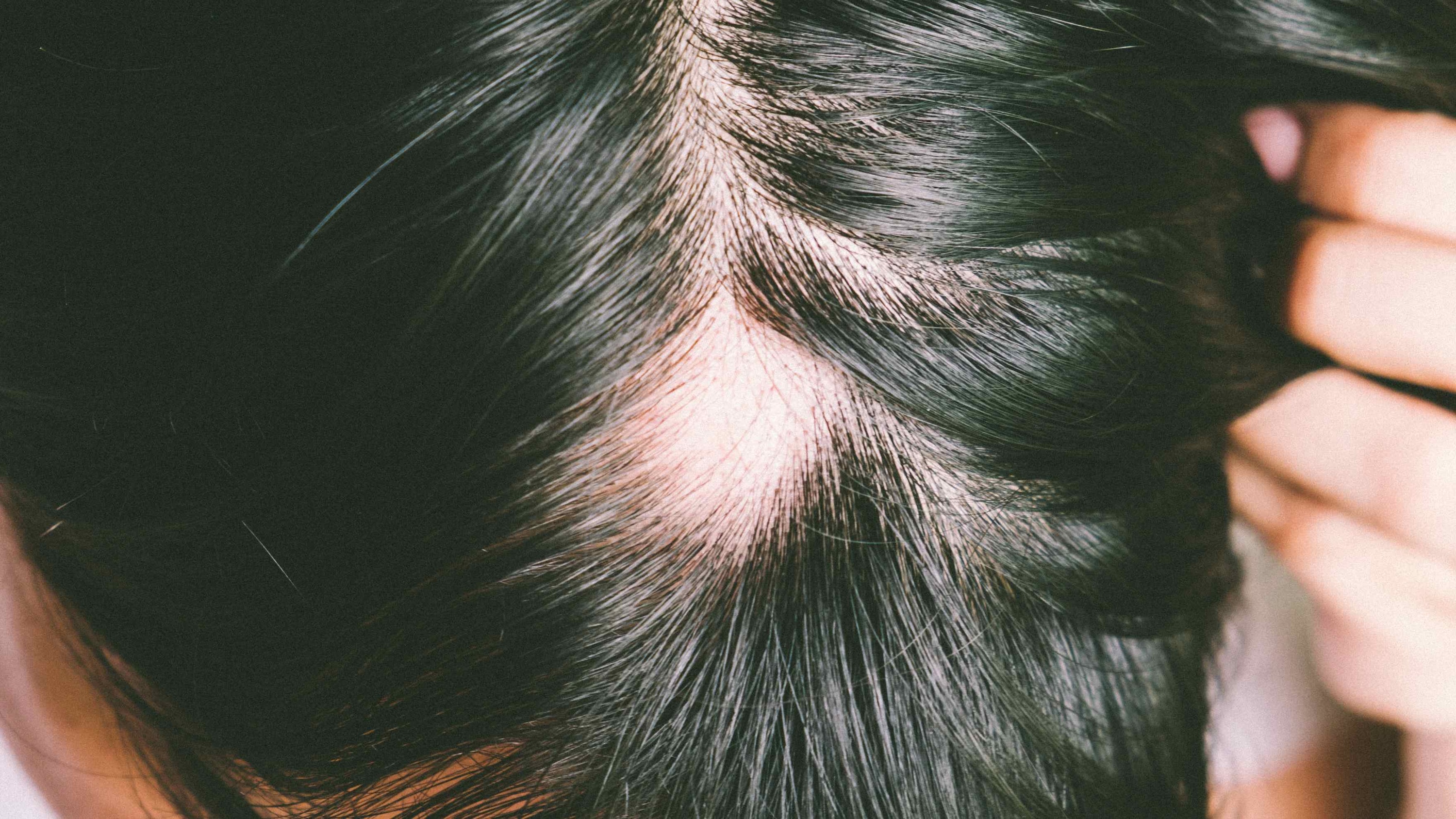 Androgenetic Alopecia Image