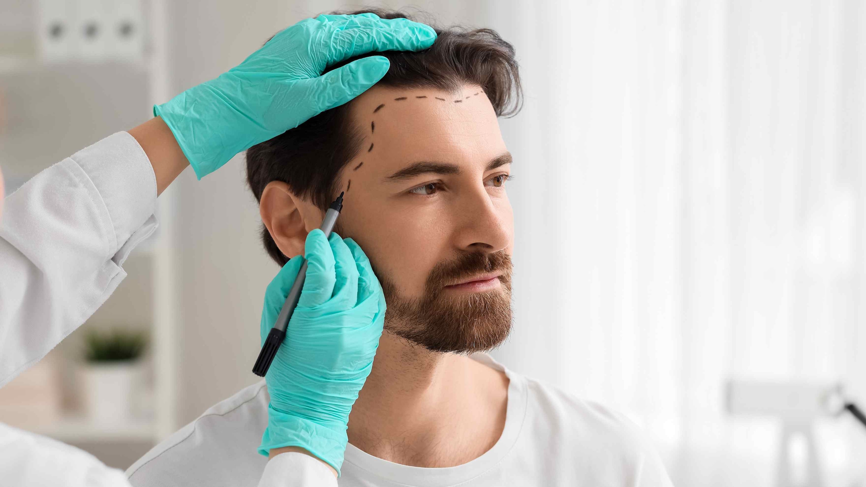 Hair Transplants Image