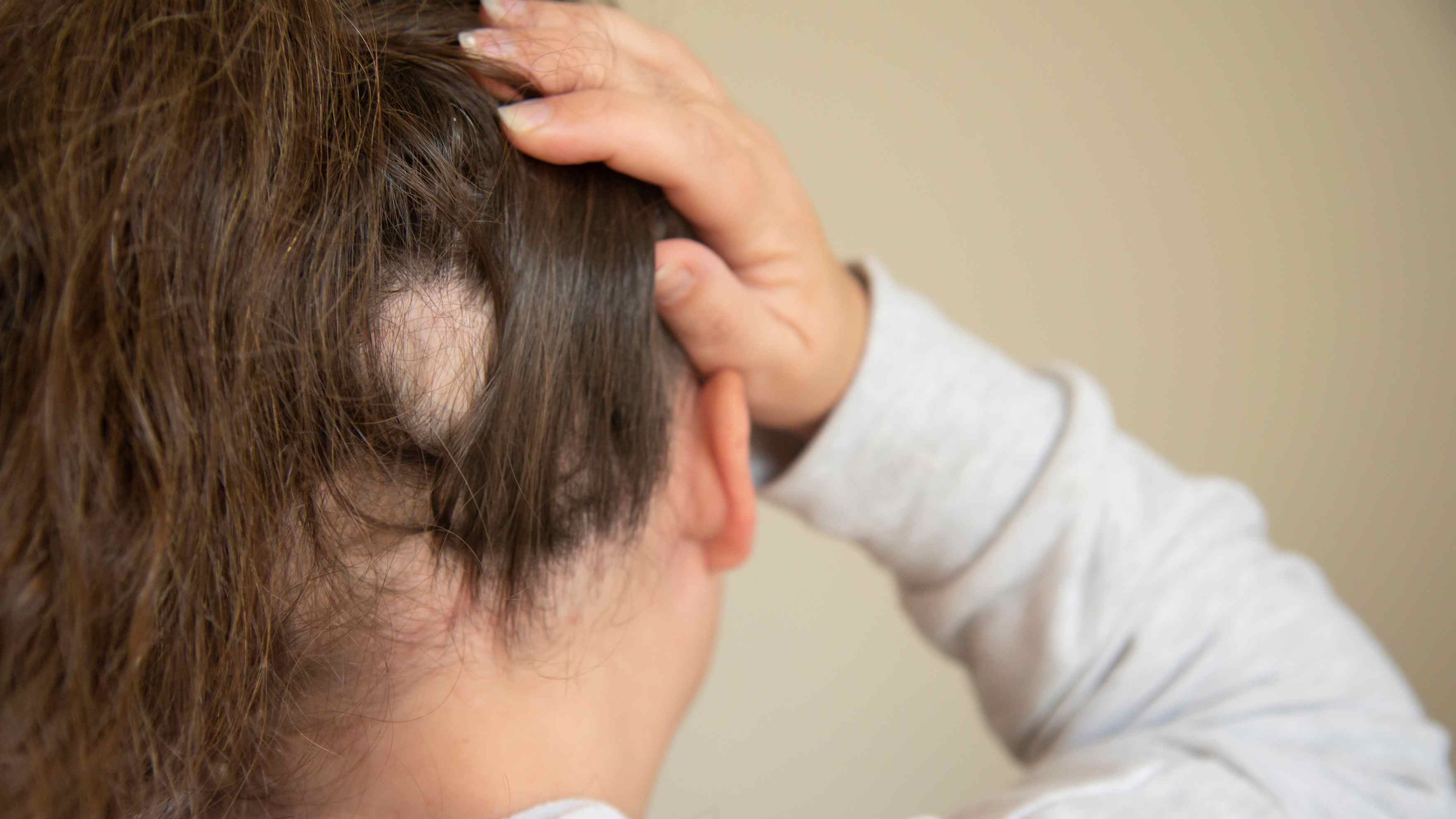 Scarring Alopecias Image