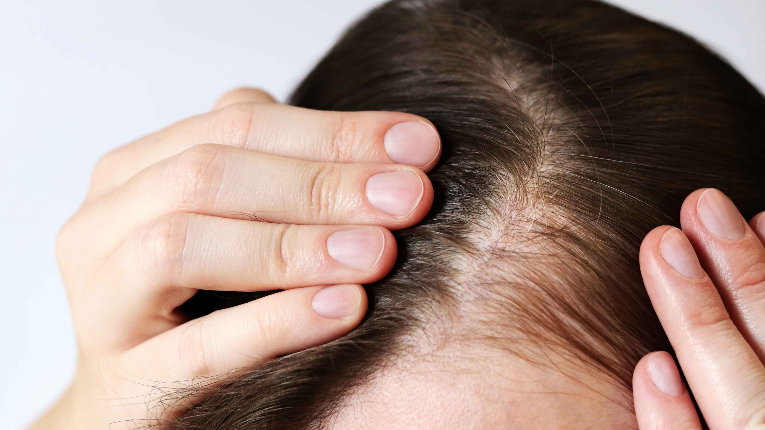 How to stop balding naturally with prevention tips
