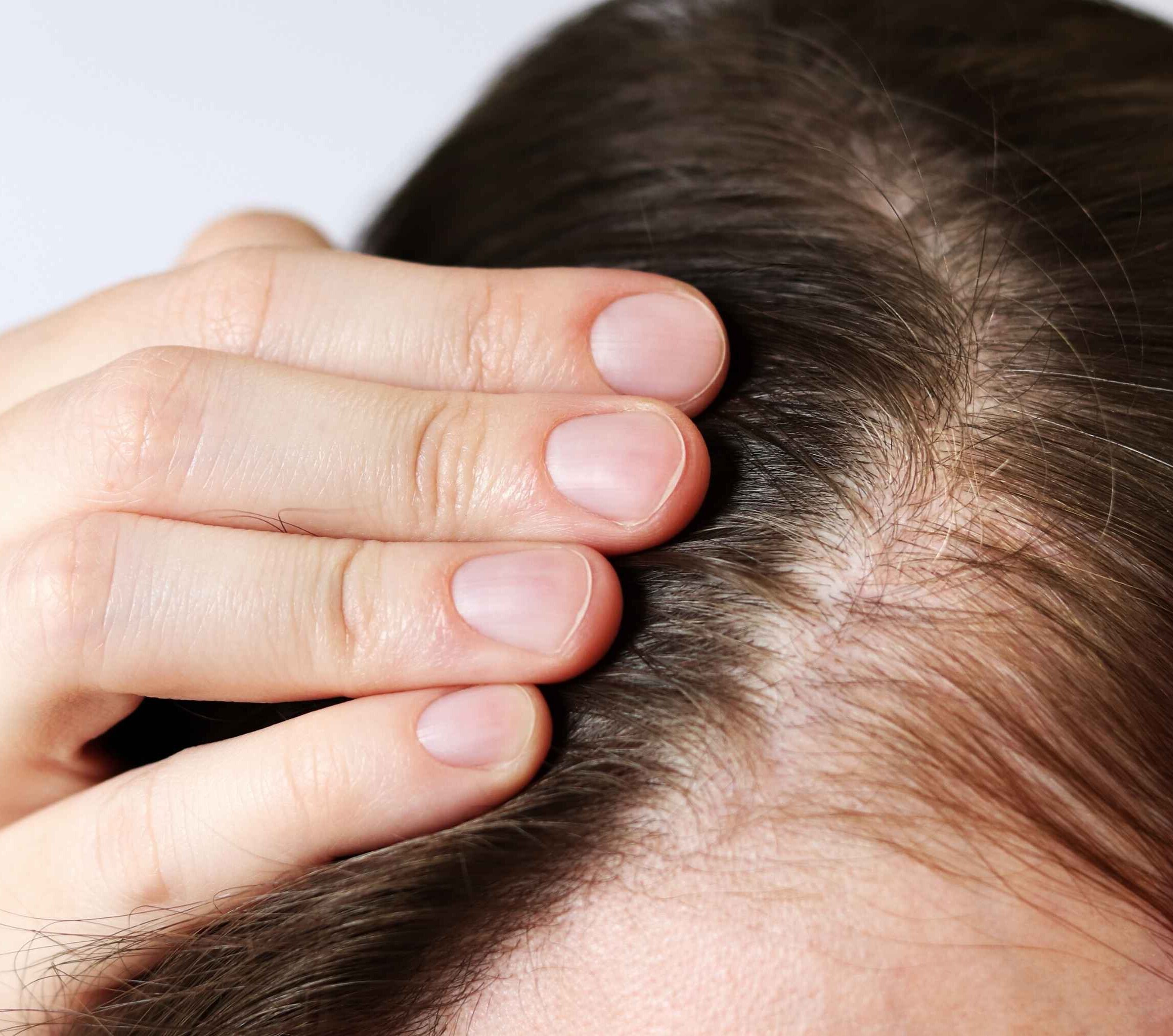 Image of How to Stop Balding: Causes, Treatments, and Prevention Tips