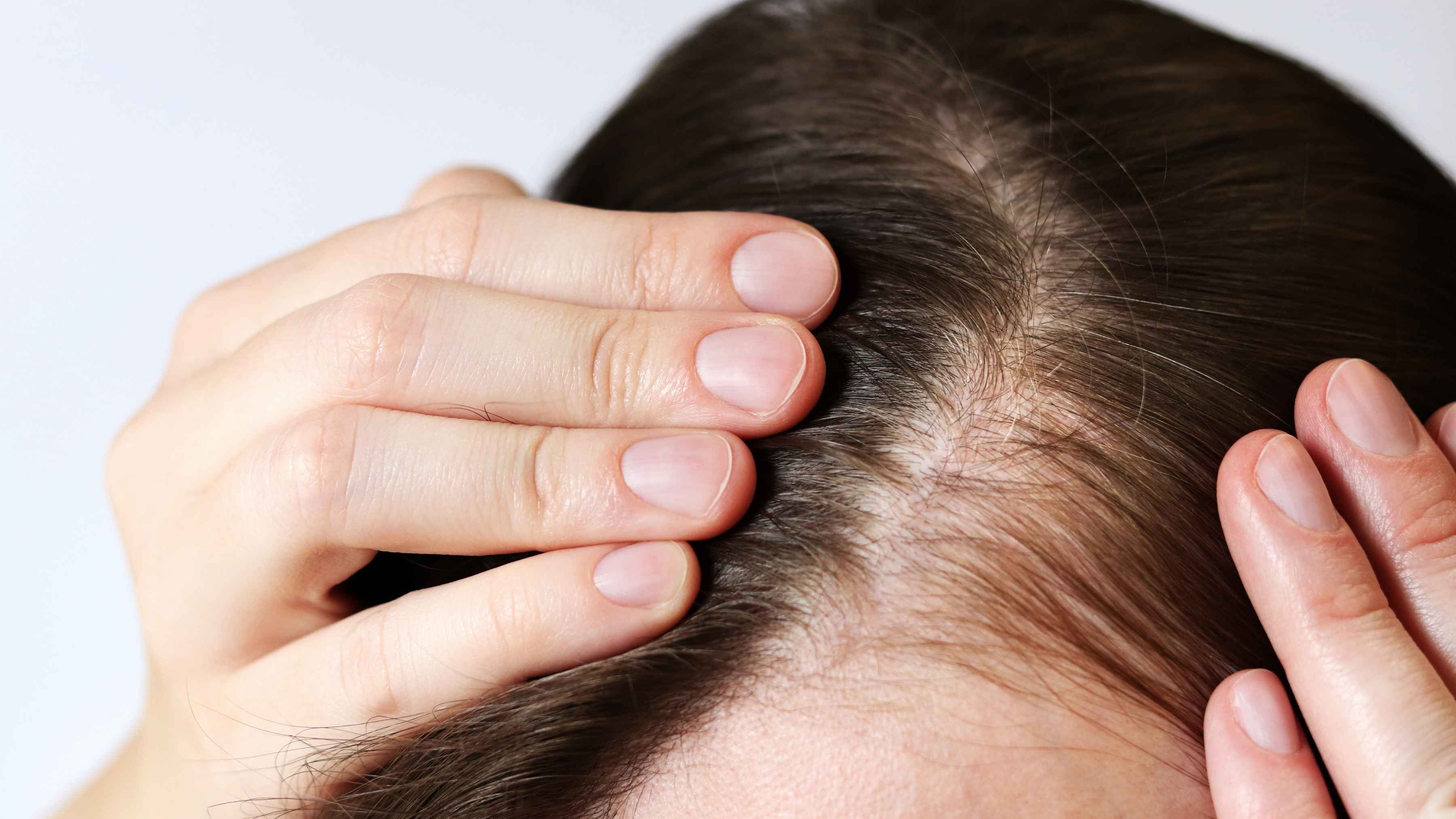 How to stop balding naturally with prevention tips