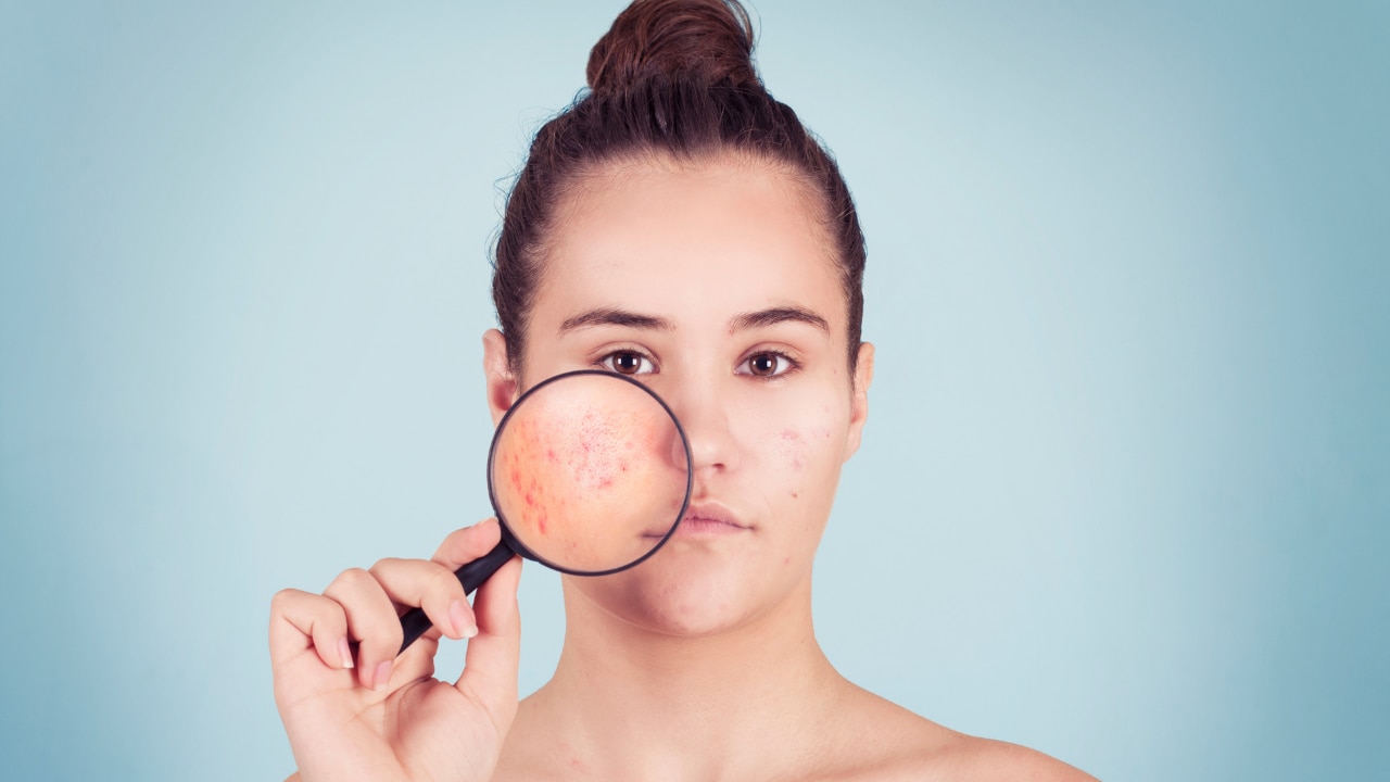 Benzoyl Peroxide Side Effects Image