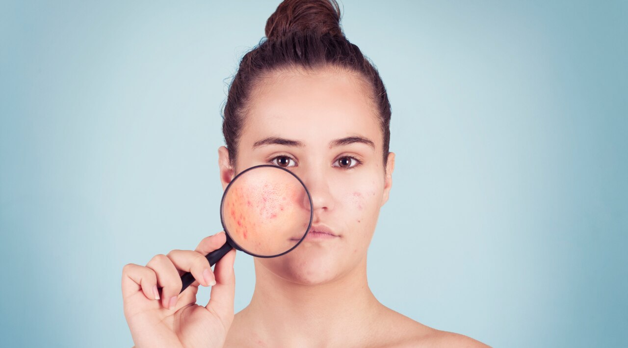 Benzoyl Peroxide Side Effects Image