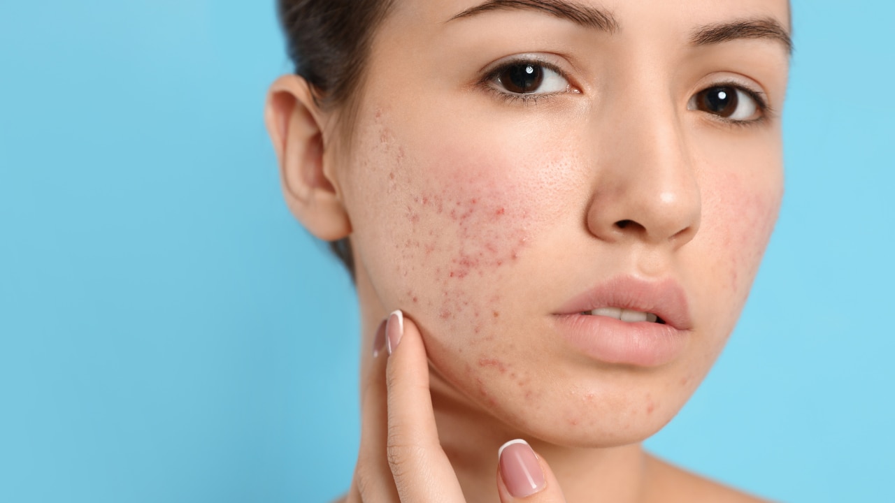 Fades Post-Acne Marks