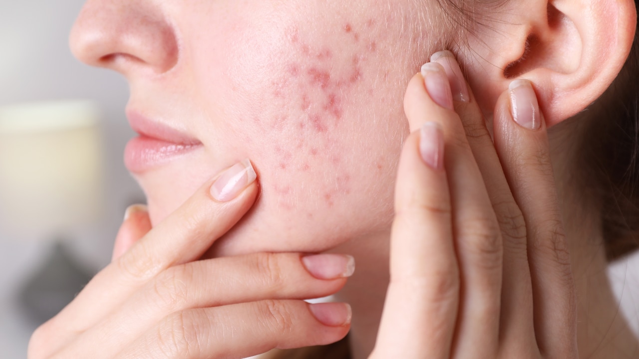 Fights Acne