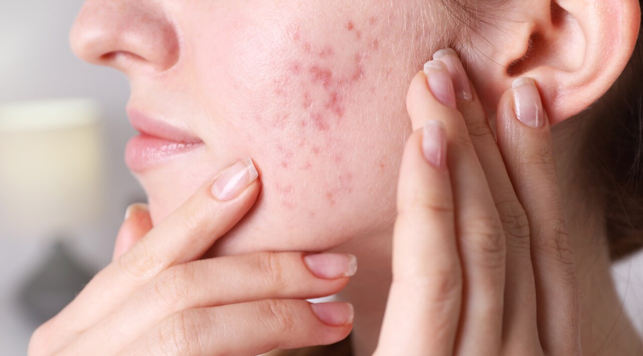 Fights Acne
