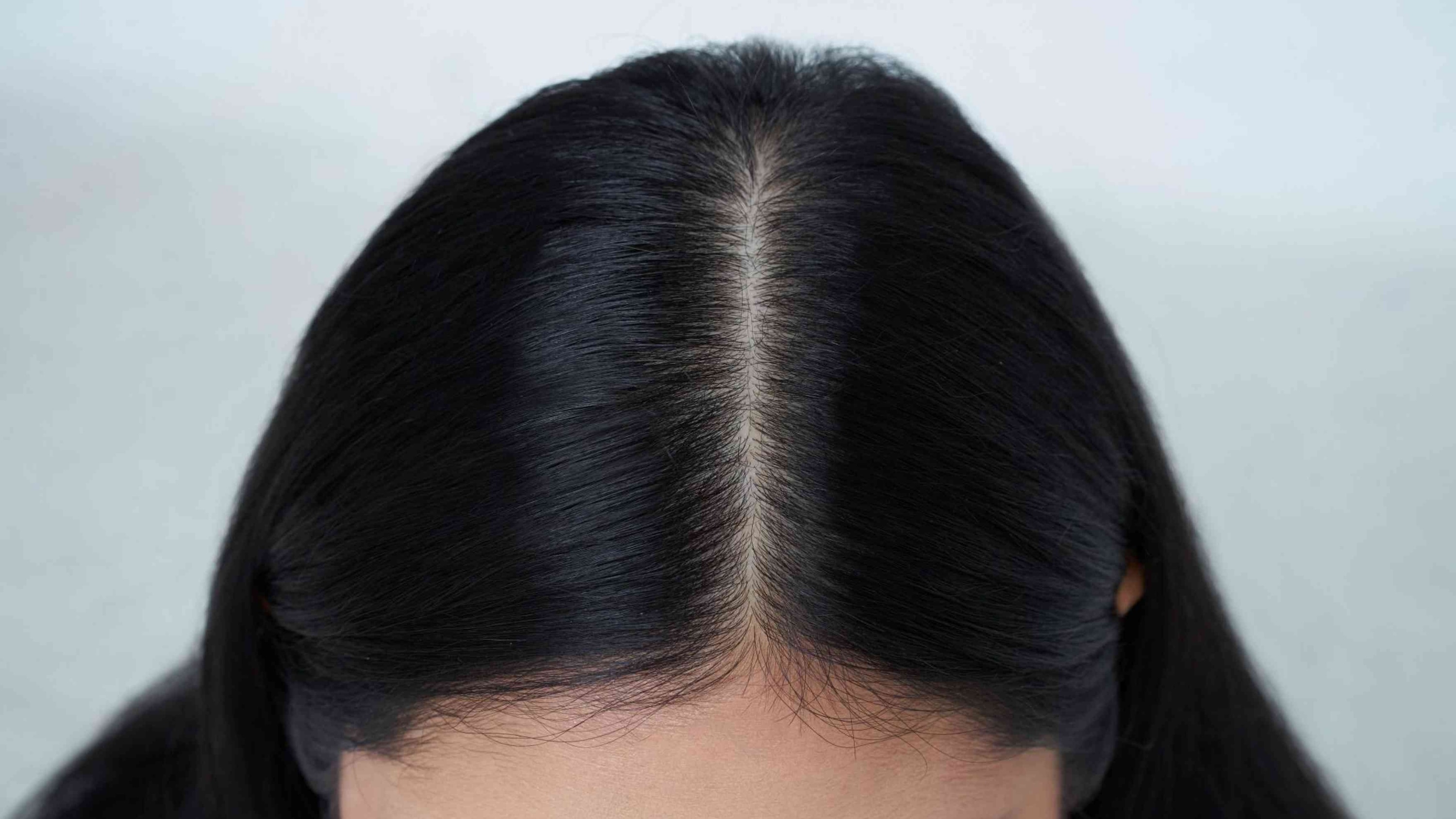 Start with a Clean Scalp Image
